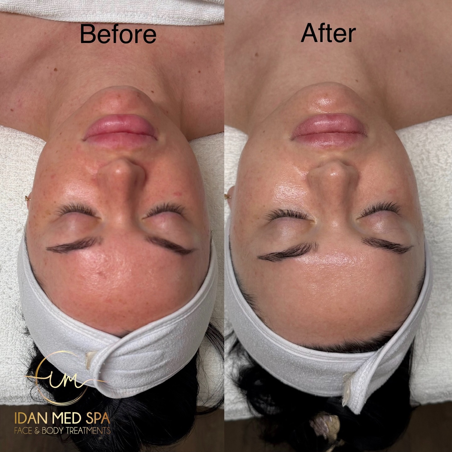 Looking for the secret to glowing, youthful skin? Our Salmon DNA Facial helps repair, hydrate, and rejuvenate your skin from within.
This advanced treatment helps:
• Boost collagen production
• Improve skin texture & elasticity
• Deeply hydrate the skin
• Reduce fine lines and dullness
• Repair damaged skin cells
Your skin will look brighter, smoother, and healthier after just one treatment.
Perfect for anyone who wants that natural glass-skin glow.
📍 Idan Med Spa
📞 818-661-2524
🌐 idanmedspa.com
Intro price available – Book your appointment today!