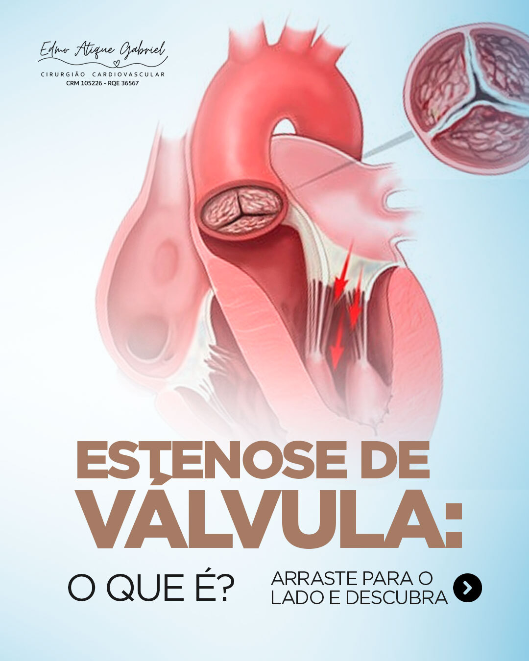 A estenose valvar é uma condição silenciosa no começo, mas que pode trazer riscos importantes à saúde do coração quando evolui.
Ela ocorre quando uma das válvulas cardíacas se estreita, dificultando a passagem do sangue e forçando o coração a trabalhar além do normal. A estenose da válvula aórtica é a mais frequente e merece atenção especial.
O diagnóstico precoce faz toda a diferença para indicar o melhor tratamento e evitar complicações.
Sentiu cansaço fora do normal, falta de ar ou tontura? Procure avaliação especializada.
Cuidar do coração é cuidar da vida.
#SaúdeDoCoração #Cardiologia #EstenoseValvar #CoraçãoSaudável #VálvulaCardíaca #Prevenção #SaúdeCardiovascular #CuideDoCoração #Medicina #VidaComSaúde