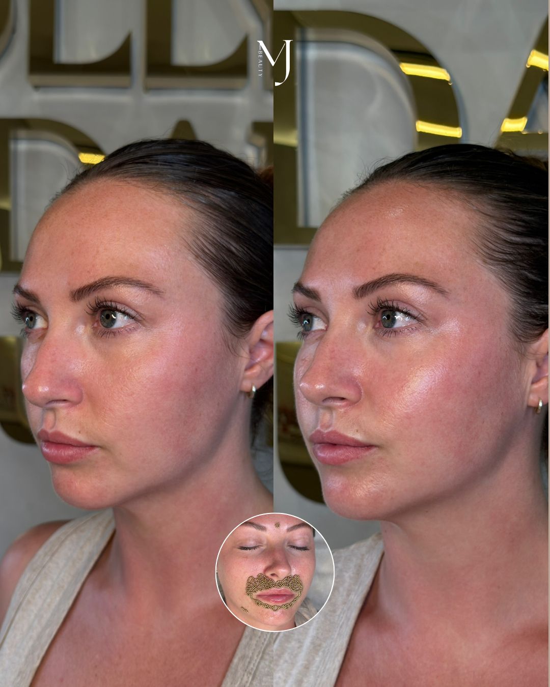 One session. Visible results. â¨â
â
If your lips have been looking thinner, or your lower face feels softer than it used to, this treatment is for you. đ¤â
â
As we move through our 30s and beyond, collagen naturally diminishes and itâs often first noticeable around the mouth and jawline. Lips lose fullness, and the lower face can start to lose its definition.â
â
Our Qi Beauty Lower Face Lift + Lip Volume treatment works with your body, not against it. Using magnetic beads, it stimulates circulation and collagen production to restore natural plumpness, lift, and definition over time.â
â
Add this onto any treatment using the code QILIPS50 and you will get 50% off! Valid for March only đ¤