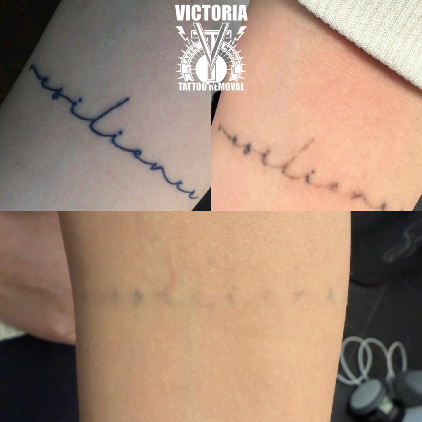 Thinking about Tattoo Removal? We are here for you - If it’s for full removal or just lighting up for a cover-up. We got you covered!! Book an appointment on line today