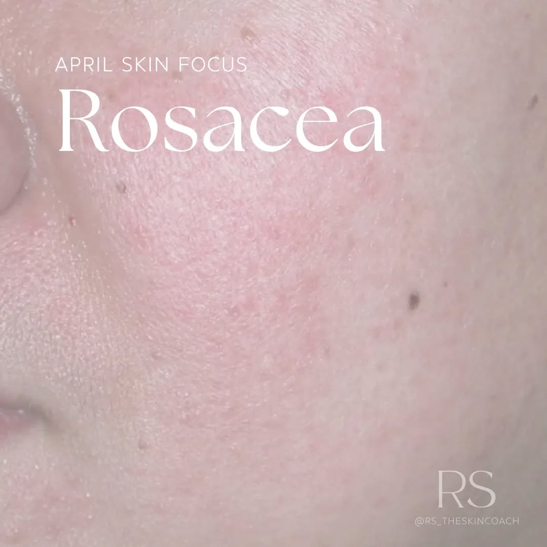 Rosacea Awareness Month
For over 30 years, April has been designated as Rosacea Awareness Month to help raise awareness and educate on this chronic and complex skin condition.
My personal journey with Rosacea began in my 20's. It took me a while to understand what was going on with my skin and the adjustments I had to make to control the flare-ups.
Skin is complicated at the best of times, but throwing Rosacea into the mix can affect you emotionally as well as some of the uncomfortable physical symptoms. When it comes to healing Rosacea, it is definitely a marathon and not a sprint.
As every skin is different, so is your Roascea.
I work with clients to help you understand your skin and work on achieving your skin goals.
Through skin coaching, we will work on a principle of Corneotherapy by treating your skin first and symptoms second. As Rosacea is associated with a compromised skin barrier, we have to work on this first. It's a bit like having a leak in the roof of your house. We have to fix this first!
Through a combination of Bespoke Facials and Skin Coaching we can create a plan of action to help your skin improve and manage your symptoms.
Please feel free to get in touch or ask any questions below.
#rosacea
#Facialist
#rosaceaawarenessmonth
#skintherapist
#skincoaching