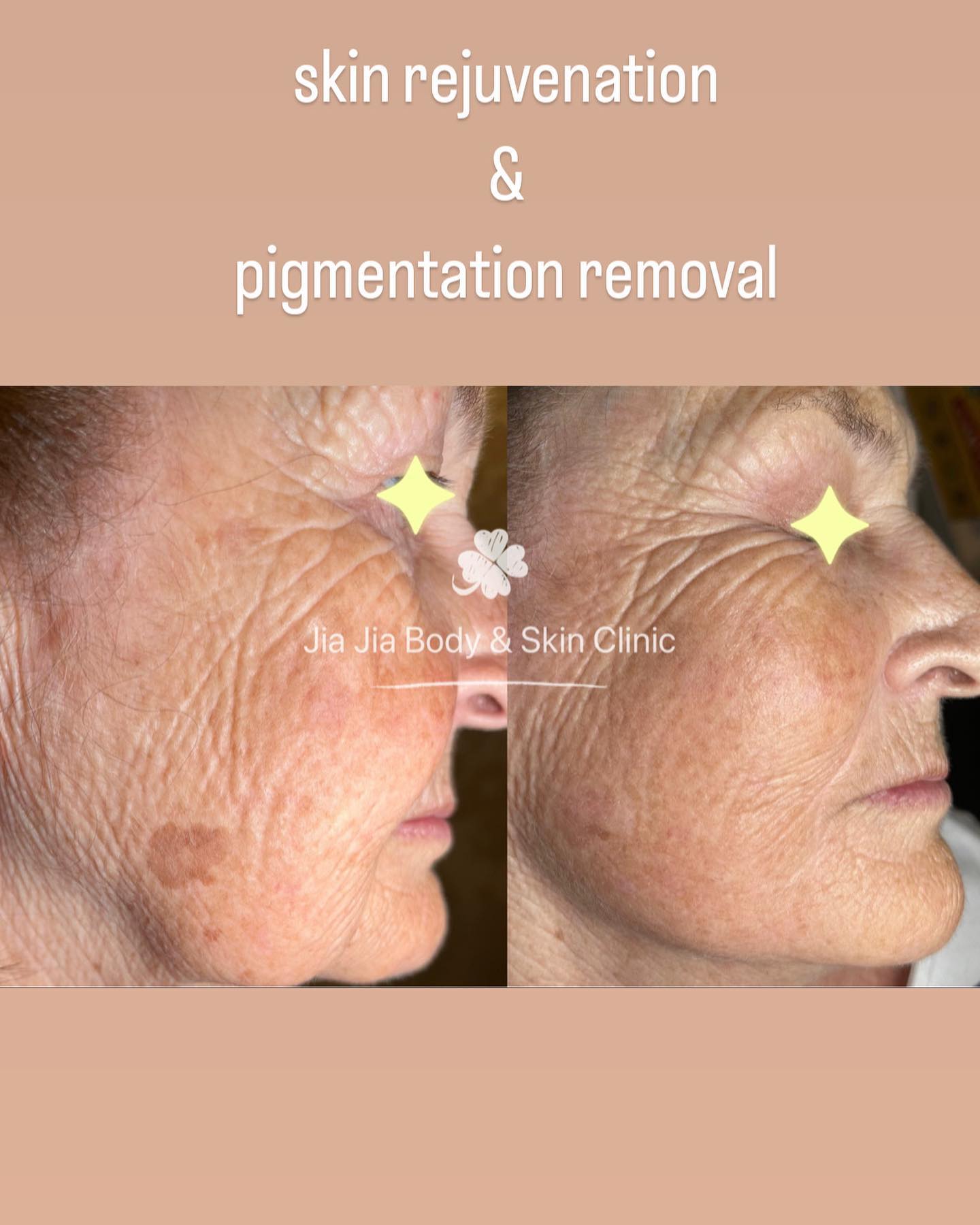 Achieve a more even skin tone with Alma Dye SR! This laser treatment targets pigmented lesions to leave your skin looking smoother and more radiant. It's quick, easy, and delivers real results without surgery or downtime. Say goodbye to pigmentation and hello to clear, beautiful skin with Alma Dye SR. #almadyesr #skintreatment #pigmentation #clearskin #beauty#almaharmonyxlpro #almaaustralis