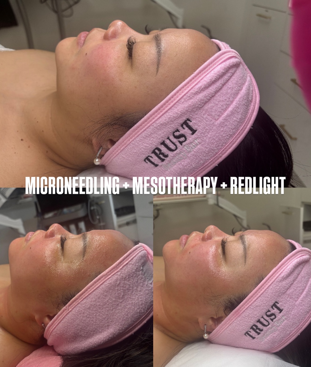 𝗠𝗜𝗖𝗥𝗢𝗡𝗘𝗘𝗗𝗟𝗜𝗡𝗚 + 𝗠𝗘𝗦𝗢𝗧𝗛𝗘𝗥𝗔𝗣𝗬 + 𝗥𝗘𝗗 𝗟𝗜𝗚𝗛𝗧 💡🩸
One of our favorite combinations for skin rejuvenation, collagen stimulation, and deep nutrient infusion.
This treatment combines:
✨ Microneedling to stimulate collagen and remodel the skin
💧 Mesotherapy infusion to deliver powerful serums directly into the skin
🔴 Red Light Therapy to calm inflammation and accelerate healing
Together these modalities help improve:
• Skin texture and tone
• Fine lines
• Acne scarring
• Dull or dehydrated skin
• Overall skin regeneration
For optimal results, this treatment is recommended every 4–6 weeks.
We recommend starting with a package of 3 sessions for best collagen stimulation and long-term skin improvement.
🎓 Interested in learning this treatment?
Our Advanced Microneedling Certification at Trust Academy teaches the full protocol including mesotherapy infusion techniques, treatment depths, safety, and clinical applications.
🌐 www.trust-academy.ca
#Microneedling #Mesotherapy #RedLightTherapy #SkinRejuvenation #TrustBeautyBar TrustAcademy MicroneedlingTraining