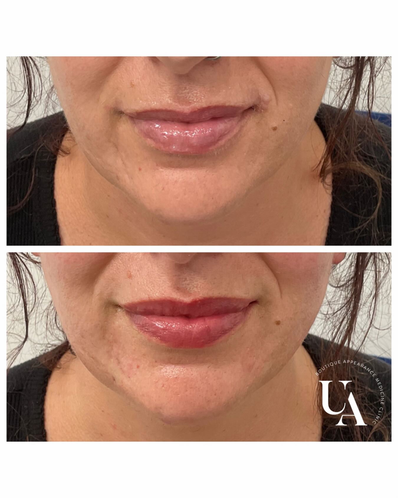 First time lippies for this beautiful lady 😍
Blessed with gorgeous lips naturally, our goal was to keep natural and simply enhance ❤️
#lipsbyrachel #lipsnz #lipskapiti #cosmeticnurse #lovemyjob
Dermal filler injections are Medical devices for the treatment of loss of volume in the skin. Dermal fillers have risks and benefits. Ask your doctor if dermal filler injections are is right for you. For further information ask your doctor or go to www.medsafe.govt.nz