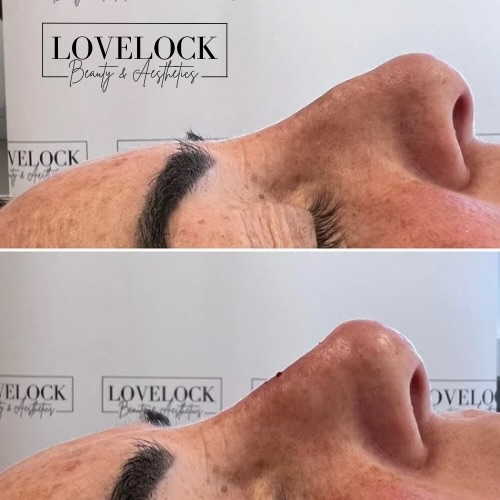 Another amazing transformation on my client!
If you don’t like the side profile of your nose, it can easily be fixed.
please feel free to get in contact.
⭐️ Award-winning level 7 aesthetic practitioner
📍 Romsey 📍 Warminster
#warminster #westbury #trowbridge #melksham #frome