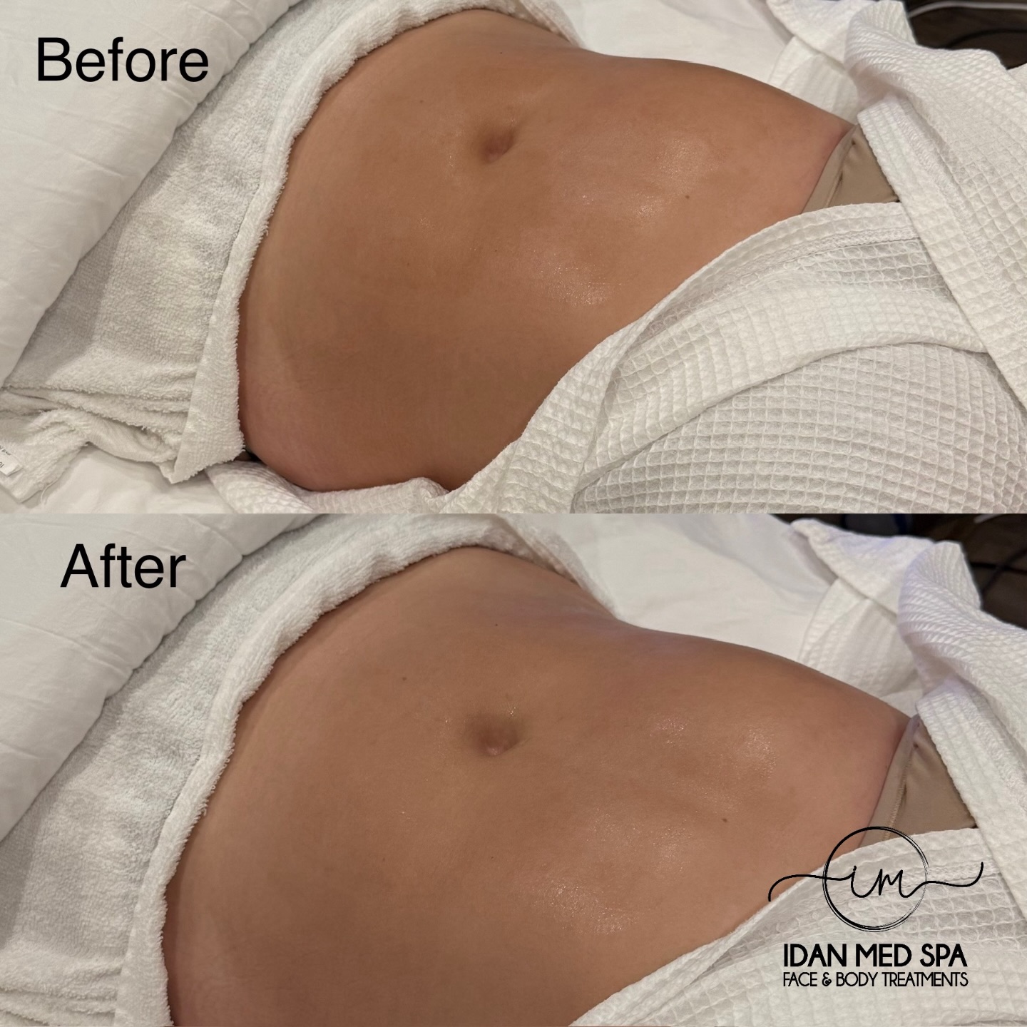 Real Results After Just ONE Session!
Looking to slim and contour your body without surgery? Our Body Cavitation & Body Contouring treatment helps break down stubborn fat, smooth the skin, and enhance your natural shape.
After just one session, you can already see visible slimming and contouring results!
✔️ Targets stubborn fat
✔️ Helps reduce inches
✔️ Non-invasive & no downtime
✔️ Smooths and contours the body
Perfect for areas like the abdomen, love handles, thighs, and arms.
Start your body transformation today and see the difference after just one visit.
📍 Visit us at Idan Med Spa
📅 Book your appointment today
#bodycontouring #bodycavitation #bodyslimming #noninvasive #medspa losangelesmedspa bodysculpting beforeandafter idanmedspa