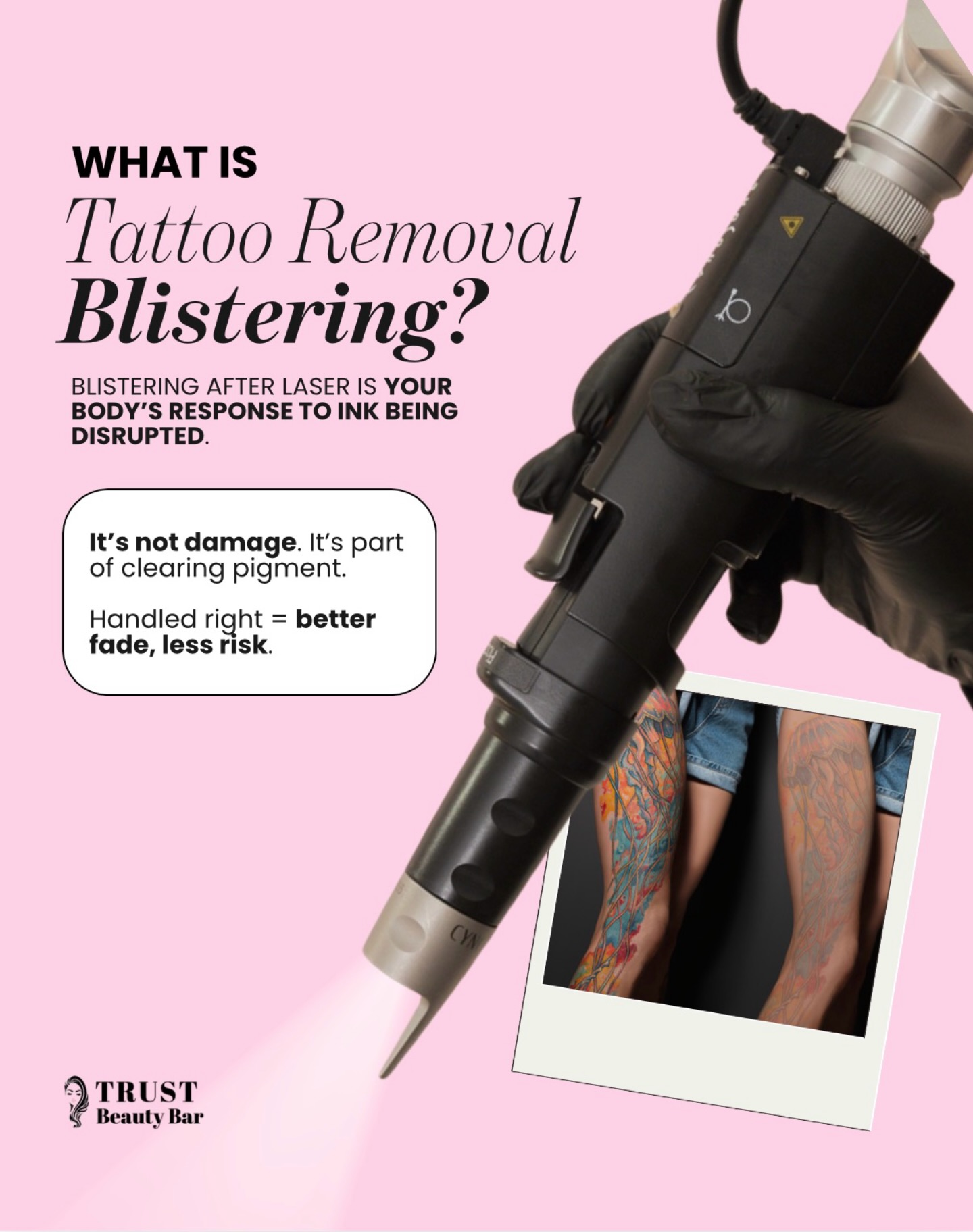 𝗪𝗛𝗔𝗧 𝗬𝗢𝗨 𝗡𝗘𝗘𝗗 𝗧𝗢 𝗞𝗡𝗢𝗪 𝗔𝗕𝗢𝗨𝗧 𝗕𝗟𝗜𝗦𝗧𝗘𝗥𝗜𝗡𝗚 𝗔𝗙𝗧𝗘𝗥 𝗟𝗔𝗦𝗘𝗥 𝗧𝗔𝗧𝗧𝗢𝗢 𝗥𝗘𝗠𝗢𝗩𝗔𝗟 👇
Blistering is one of the most misunderstood reactions post-laser… but it’s actually a normal and expected part of the healing process.
When we treat a tattoo with advanced laser technology, we’re breaking down ink particles using targeted energy. Your body then recognizes this as “damage” and initiates a controlled inflammatory response — this is where blistering can occur.
✨ 𝗪𝗛𝗬 𝗕𝗟𝗜𝗦𝗧𝗘𝗥𝗜𝗡𝗚 𝗛𝗔𝗣𝗣𝗘𝗡𝗦:
• Rapid heat + energy disrupts pigment in the dermis
• Fluid forms between skin layers as part of healing
• Your lymphatic system begins clearing fragmented ink
✨ 𝗜𝗠𝗣𝗢𝗥𝗧𝗔𝗡𝗧: 𝗧𝗛𝗜𝗦 𝗜𝗦 𝗡𝗢𝗧 𝗦𝗞𝗜𝗡 𝗗𝗔𝗠𝗔𝗚𝗘
Blistering = your body doing its job
It’s part of the pigment elimination process, not a complication when managed properly.
✨ 𝗪𝗛𝗔𝗧 𝗠𝗔𝗧𝗧𝗘𝗥𝗦 𝗠𝗢𝗦𝗧 → 𝗔𝗙𝗧𝗘𝗥𝗖𝗔𝗥𝗘
How you handle blistering directly impacts your results:
• DO NOT pop or peel blisters
• Keep the area clean + protected
• Use recommended healing ointments
• Avoid friction, heat & sun exposure
• Stay consistent with your post-care protocol
✨ 𝗪𝗛𝗬 𝗣𝗥𝗢𝗣𝗘𝗥 𝗖𝗔𝗥𝗘 𝗜𝗦 𝗖𝗥𝗨𝗖𝗜𝗔𝗟
Handled correctly:
✔️ Better ink breakdown & fading
✔️ Lower risk of scarring
✔️ Faster, healthier healing
Handled incorrectly:
❌ Increased risk of pigmentation issues
❌ Delayed healing
❌ Potential scarring
At 𝗧𝗿𝘂𝘀𝘁 𝗕𝗲𝗮𝘂𝘁𝘆 𝗕𝗮𝗿, we don’t just treat — we educate and guide every step of your healing process to ensure optimal results.
Because results aren’t just about the laser…
they’re about what happens after.
✨ SAVE THIS if you’re going through tattoo removal
📍 Book your consultation
#TattooRemoval #LaserEducation #SkinHealing #TrustBeautyBar #LaserAftercare InkRemovalJourney