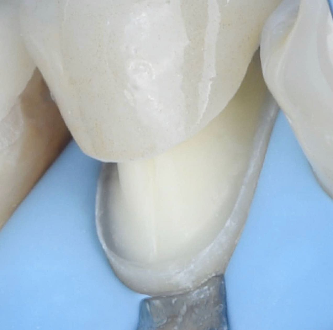 EMAX Crowns provide the best natural color match compared to any other crown type. Dental crowns are tooth-shaped “caps” that can be placed over your tooth. The dental crown is cemented into place on your tooth and it covers the visible portion of the tooth.
-
https://www.veneers.istanbul
-
WhatsApp: 00905330164562
-
#veneers #smiledesign #cosmeticdentistry #restorativedentistry #emax #veneer #laminates #zirconia #zirconium #hollywoodsmile #dentalcrowns #crowns #veneersistanbul #porcelainveneers #emaxveneers