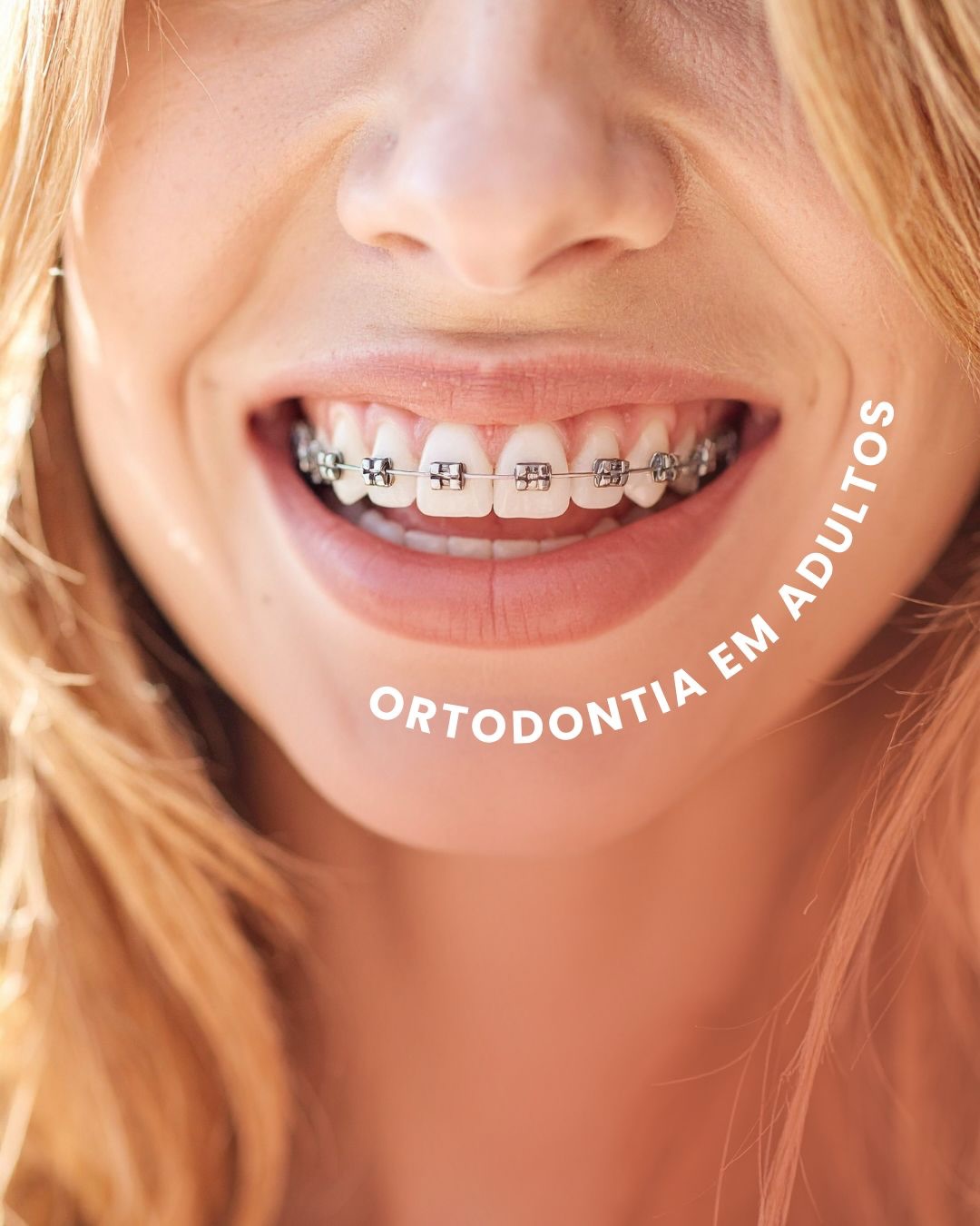 Durante muitos anos a ortodontia foi associada apenas à adolescência.
Hoje vemos cada vez mais adultos iniciando tratamentos — principalmente por causa das novas tecnologias.
Alinhadores transparentes, aparelhos mais discretos e planejamentos digitais tornaram o tratamento muito mais confortável.
📍 Pindamonhangaba
Agende sua avaliação.