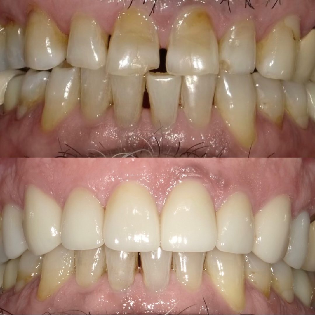 Since i can remember my father was a smoker. I remember the first paper I wrote in dental school was the side effects of smoking on dental health. I sent it to my father in hopes he would kick the habit. It was a long journey with ups and downs but he finally quit smoking 20 years later. The results were evident on his teeth. I use to joke around with him and tell him he couldn’t tell people his daughter was a dentist while still smoking. After he quit, I gave him the gift of whiter, healthier teeth, as the damage caused by nicotine was still visible. This case is deeply meaningful to me, as it holds a special place in my heart. I love my dad and I’ve always aimed to make him proud, and on this day his smile said it all. Love you baba 🥰🥰🥰. #QuitSmoking #FamilyLove #DentalHealth