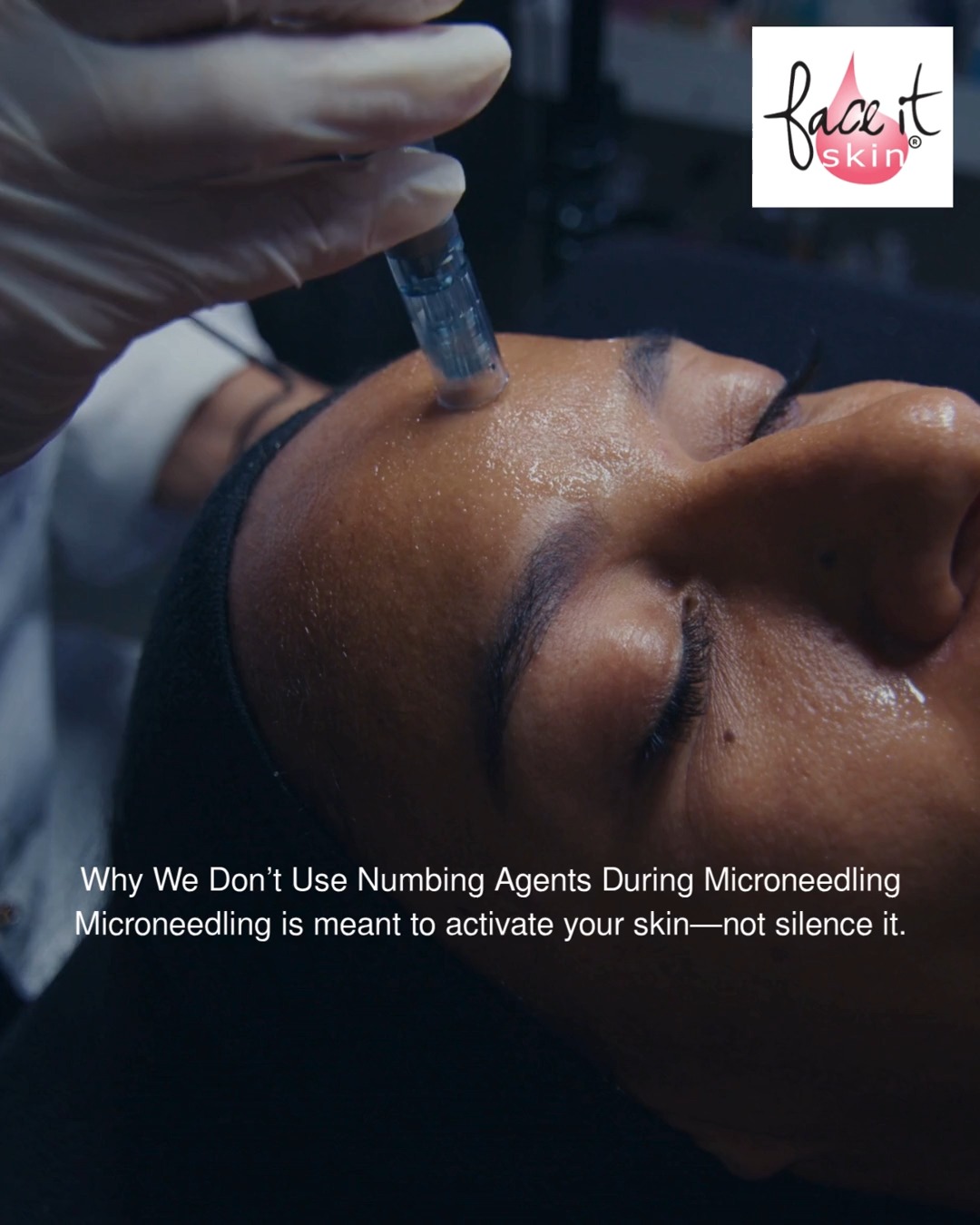 **Why We Don’t Use Numbing Agents During Microneedling**
Microneedling is meant to activate your skin—not silence it.
Your skin and nervous system are connected. When we skip numbing agents, your body fully registers the treatment, supporting stronger collagen stimulation, better circulation, and more effective repair.
🧪It's science + biology = healthier skin response.
Numbing creams may reduce discomfort—but they can also interfere with results. Many contain ingredients that constrict blood flow or alter how your skin responds.
And with microneedling, absorption changes.
Creating microchannels increases penetration, meaning more of what’s applied can enter the bloodstream.
Numbing cream does not evaporate like alcohol does on the skin.
Here’s where it becomes a concern:
• Increased absorption during treatment
• Potential for irritation or sensitization
• Rare—but real—systemic effects like dizziness or nausea when overused
• Disruption of your skin’s natural response
Bottom line: it’s not “toxic” in the way people say—but it’s not neutral either.
Our approach is different:
• We adjust depth intentionally—not aggressively
• We support your barrier before, during, and after
• We rely on your skin’s natural response for real results
You’ll feel it—but that feedback matters.
Real skin change requires communication between your skin, brain, and body.
Want to be a client or are you a pro and want training? DM me to schedule or copy & paste: faceitskin.net
👉Link in BIO.
#FaceItSkin #Microneedling #SkinHealth #pnwlife #EstheticianLife