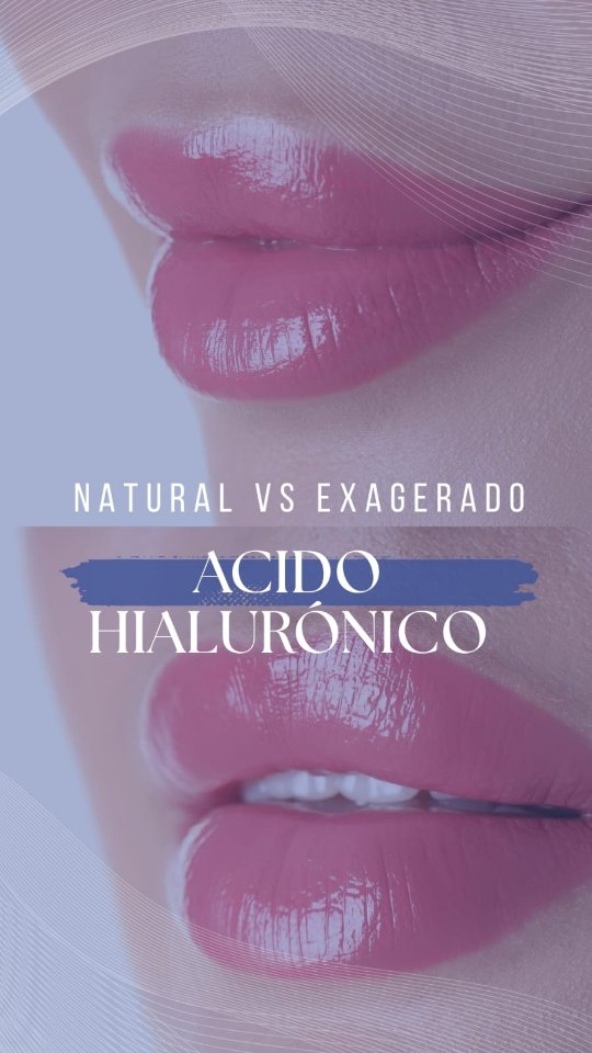 ¿Labios naturales o "labios de pato"? 🦆👄 La diferencia absoluta está en la técnica y en las manos de quien la aplica.
Si estás buscando un aumento de labios con ácido hialurónico en Bogotá que se vea armónico y resalte tu belleza natural, esto es lo que debes saber:
✨ Labios Naturales: Se logra respetando la anatomía de tu boca. Usamos la cantidad exacta de producto y lo aplicamos en las capas correctas para dar hidratación, definición y un volumen sutil.
⚠️ "Labios de Pato" (Duck Lips): Ocurren por exceso de relleno o una mala técnica donde el ácido hialurónico se inyecta fuera del músculo o migra por encima del borde del labio, perdiendo por completo la forma natural.
Tu rostro no es un juego. Acudir a un médico calificado es vital no solo para garantizar un resultado estético hermoso, sino para tu seguridad. Un experto conoce la anatomía facial a la perfección, lo que evita complicaciones graves como asimetrías, nódulos o problemas vasculares.
En EWAH (Experts on Wellness And Health), la Dra. Lorena Pinzon se especializa en realzar tu belleza con los más altos estándares médicos y estéticos.
Agenda tu valoración en el link de nuestra bio y descubre la mejor versión de tus labios. 👇
#AumentoDeLabiosConAcidoHialuronicoEnBogota #AumentoDeLabiosBogota #AcidoHialuronicoBogota #LabiosNaturalesBogota #MedicinaEsteticaBogota DraLorenaPinzon EWAH ArmonizacionFacialBogota EsteticaBogota RellenoDeLabiosBogota DiseñoDeLabios SaludYBienestar