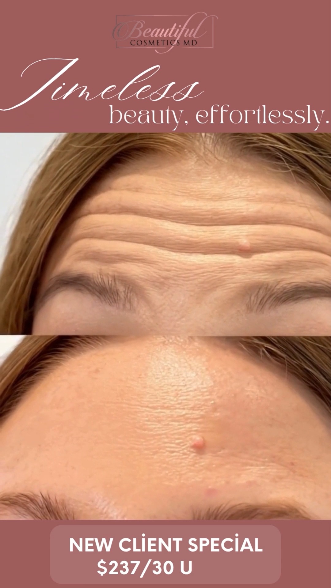 Less lines, more glow 💉✨
Fast and simple. Still looks like you.
Reserve your spot today.
https://optin.beautifulcosmeticsmd.com/leslie-rn-booking-page
#SkinGoals #YouthfulSkin #selfcare #BeautifulCosmeticsMD #Chino #california
www.beautifulcosmeticsmd.com
📍 Beautiful Cosmetics MD
3857 Schaefer Ave, Chino, CA 91710, United States