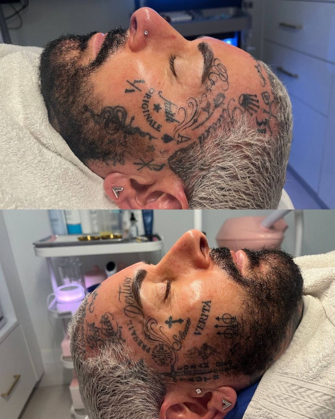 𝗠𝗲𝗻’𝘀 𝗦𝗸𝗶𝗻 𝗶𝘀 𝗗𝗶𝗳𝗳𝗲𝗿𝗲𝗻𝘁 — 𝗬𝗼𝘂𝗿 𝗙𝗮𝗰𝗶𝗮𝗹 𝗦𝗵𝗼𝘂𝗹𝗱 𝗕𝗲 𝗧𝗼𝗼.
Men’s skin is naturally 𝗍𝗁𝗂𝖼𝗄𝖾𝗋, 𝗈𝗂𝗅𝗂𝖾𝗋, 𝖺𝗇𝖽 𝗆𝗈𝗋𝖾 𝗉𝗋𝗈𝗇𝖾 𝗍𝗈 𝖼𝗈𝗇𝗀𝖾𝗌𝗍𝗂𝗈𝗇 — especially with daily shaving, sweat, and environmental buildup.
This is where 𝗛𝘆𝗱𝗿𝗮𝗙𝗮𝗰𝗶𝗮𝗹 isn’t a luxury… it’s maintenance.
✨ 𝗪𝗵𝗮𝘁 𝘄𝗲’𝗿𝗲 𝘁𝗮𝗿𝗴𝗲𝘁𝗶𝗻𝗴:
• Deep pore congestion + blackheads
• Ingrown hairs + shaving irritation
• Excess oil production
• Texture + dullness
• Early signs of aging
💧 𝗛𝘆𝗱𝗿𝗮𝗙𝗮𝗰𝗶𝗮𝗹 𝗳𝗼𝗿 𝗺𝗲𝗻:
This isn’t your basic facial. We’re using 𝗺𝗲𝗱𝗶𝗰𝗮𝗹-𝗴𝗿𝗮𝗱𝗲 𝘃𝗼𝗿𝘁𝗲𝘅 𝘁𝗲𝗰𝗵𝗻𝗼𝗹𝗼𝗴𝘆 to:
✔️ Extract impurities without trauma
✔️ Infuse antioxidants + hydration
✔️ Calm inflammation from shaving
✔️ Restore skin barrier function
🔥 𝗪𝗵𝘆 𝗶𝘁 𝗺𝗮𝘁𝘁𝗲𝗿𝘀:
Ignoring your skin leads to 𝗰𝗵𝗿𝗼𝗻𝗶𝗰 𝗰𝗼𝗻𝗴𝗲𝘀𝘁𝗶𝗼𝗻, 𝗶𝗻𝗳𝗹𝗮𝗺𝗺𝗮𝘁𝗶𝗼𝗻, 𝗮𝗻𝗱 𝗽𝗿𝗲𝗺𝗮𝘁𝘂𝗿𝗲 𝗮𝗴𝗶𝗻𝗴.
Consistent treatments = 𝗰𝗹𝗲𝗮𝗻𝗲𝗿 𝗽𝗼𝗿𝗲𝘀, 𝘀𝗺𝗼𝗼𝘁𝗵𝗲𝗿 𝘁𝗲𝘅𝘁𝘂𝗿𝗲, 𝗵𝗲𝗮𝗹𝘁𝗵𝗶𝗲𝗿 𝘀𝗸𝗶𝗻.
📆 𝗥𝗲𝗰𝗼𝗺𝗺𝗲𝗻𝗱𝗲𝗱 𝗲𝘃𝗲𝗿𝘆 𝟰–𝟲 𝘄𝗲𝗲𝗸𝘀 for optimal skin health.
This is 𝗻𝗼𝘁 𝗷𝘂𝘀𝘁 𝘀𝗸𝗶𝗻𝗰𝗮𝗿𝗲… 𝘁𝗵𝗶𝘀 𝗶𝘀 𝘀𝗸𝗶𝗻 𝗱𝗶𝘀𝗰𝗶𝗽𝗹𝗶𝗻𝗲.
Book your treatment with 𝗧𝗥𝗨𝗦𝗧 𝗕𝗲𝗮𝘂𝘁𝘆 𝗕𝗮𝗿 🤍
Where results meet intention.
#MensFacial #HydraFacial #SkinHealth #MensGrooming #explorepage✨