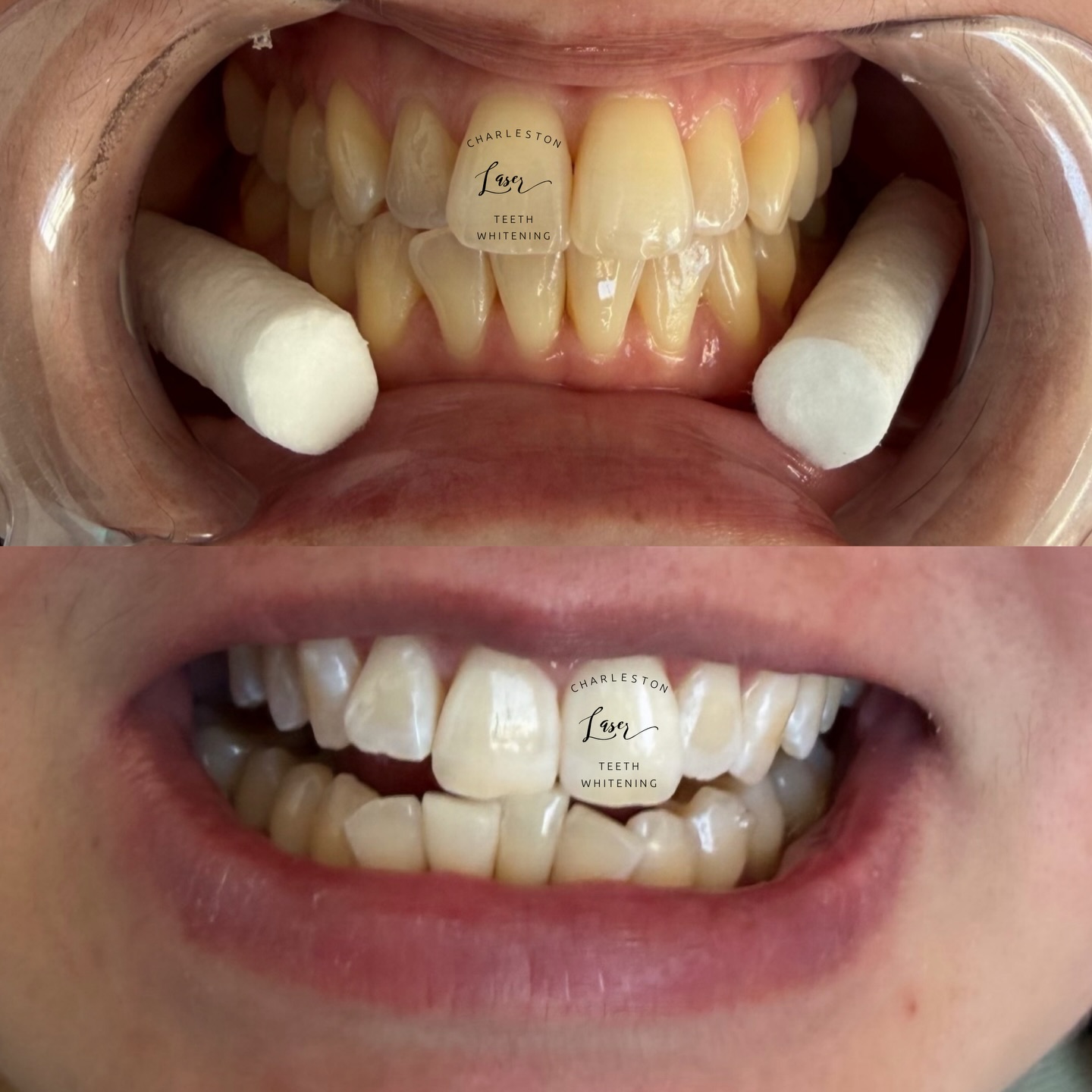 Sip your brew, enjoy the view
Dark little drops do what they do…
But one hour here, and just like that...
Your smile snaps back, white and intact. 👩🏭✨😁
Book your post St Patty's Day Teeth Whitening now! 🍀🍺
www.CharlestonLaserTeethWhitening.com
Book your teeth whitening now!
www.CharlestonLaserTeethWhitening.com
#teethwhitening #charlestonteethwhitening #charleston #charlestonsc laserteethwhitening #charlestonlaserteethwhitening mountpleasant mountpleasantsc kiawahisland kiawahjamesisland westashley isleofpalms downtowncharleston sullivansisland johnsisland johnsisland northcharleston northcharlestonsc folly follybeach downtowncharleston