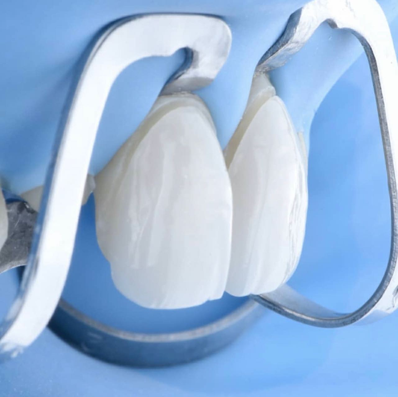 Get Veneers In Turkey! During Veneer procedure, to prepare the teeth, the dentist usually removes a small amount of enamel from the front and sides of the teeth (0.3mm). This makes room for the veneers so that your teeth look natural.
-
https://www.veneers.istanbul
-
WhatsApp: +905330164562
-
#veneers #smiledesign #cosmeticdentistry #restorativedentistry #emax #veneer #laminates #zirconia #zirconium #hollywoodsmile #dentalcrowns #crowns #veneersistanbul #porcelainveneers #emaxveneers