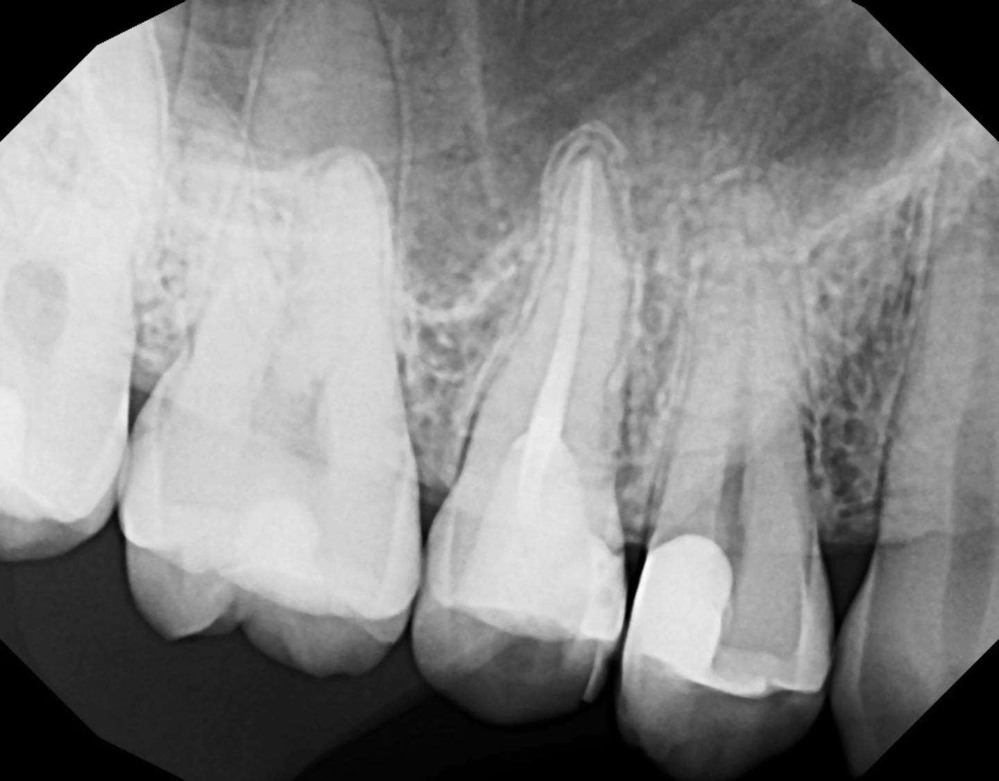 I am learning to enjoy endodontics a little more now, I followed @i_love_the_pulp's protocol, I even cut the GP the way he does, I put a lot of love and efficiency into this 14 RCT.
A little history about this case, patient came in into the clinic and saw previous dentist for facial swelling and pain, they did a 15 RCT and that did not resolve the symptoms.
I inherited the case and did my own testing (cold test, percussion and some intuition..) decided that 14 is the culprit and I need to access the tooth and perform an O&D at least to get her out of pain.
I had a diagnosis in my mind, necrotic pulp and apical periodontitis 🤓 .. lets see 😅
I opened the tooth and the necrotic smell came out right away and the tissue looked necrotic and there was no heme which indicates that this tissue is def necrotic or in that zombie stage..
I removed the infected tissue, instrumented with wave one primary, WL was 18mm B and 19mm P in hindsight I would have instrumnted 0.5mm away from apex to minimize sealer puff, I mean I like a good sealer puff but is it good? the literature is mixed on that..
anyways I followed the incredible @i_love_the_pulp's protocol and I feel like I did a good job this Saturday...
Have a blessed long weekend ✨️🩵🏝🐚🦪🦀