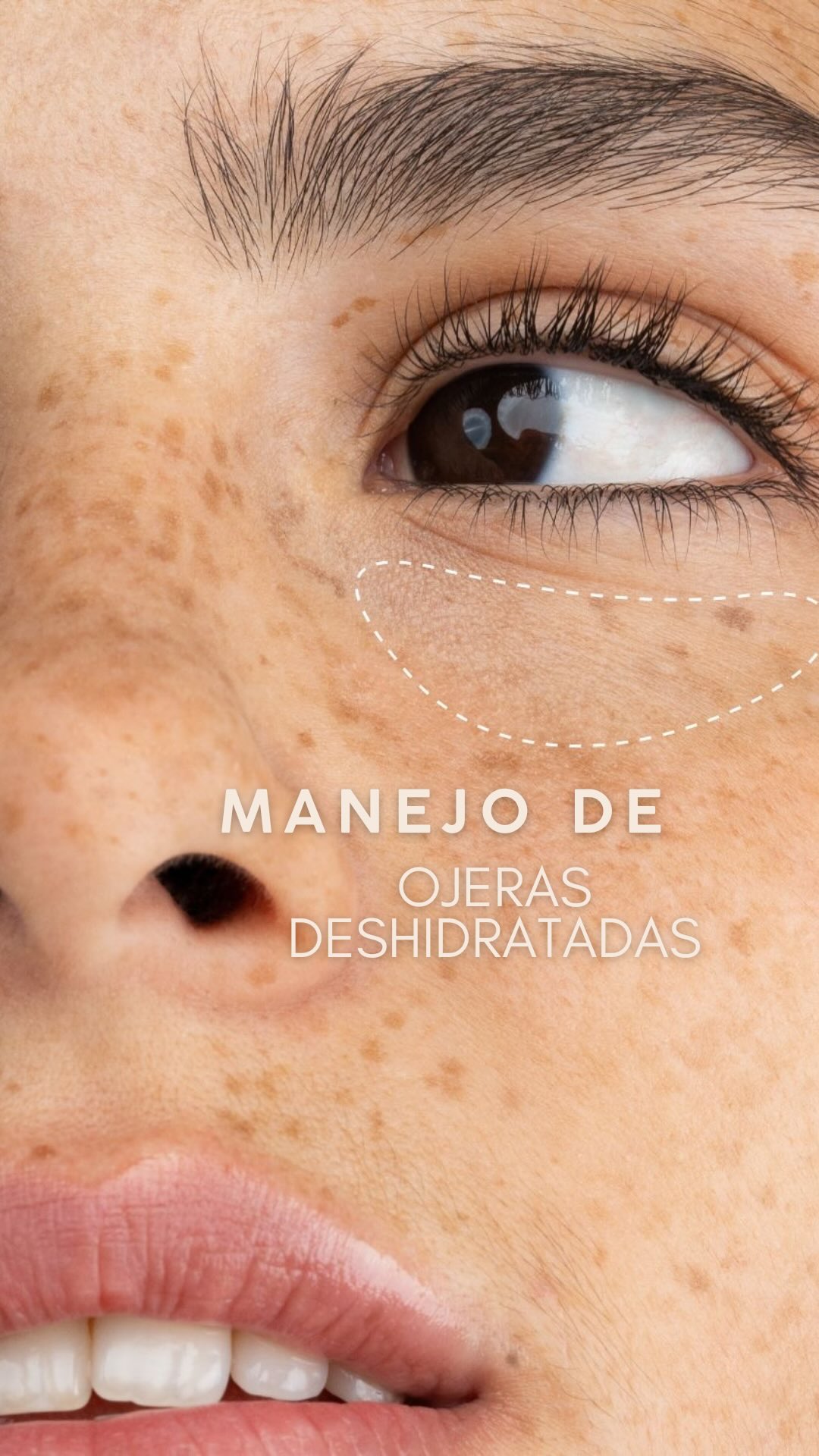 Hay algo que nadie te dice sobre las ojeras: no todo se soluciona con relleno… y definitivamente no todo se mejora con una sola sesión.
En este video te respondo las dudas más comunes sobre el NCTF en ojeras, pero desde la realidad clínica, no desde el marketing.
Porque no, no es un “milagro”.
Pero sí puede mejorar la calidad de la piel, la hidratación y la apariencia de esa zona que siempre delata el cansancio.
Si entiendes cómo funciona, entiendes por qué sí vale la pena… y en qué casos no.
La medicina estética no es prometerte perfección, es saber qué necesita tu piel y cuándo hacerlo.