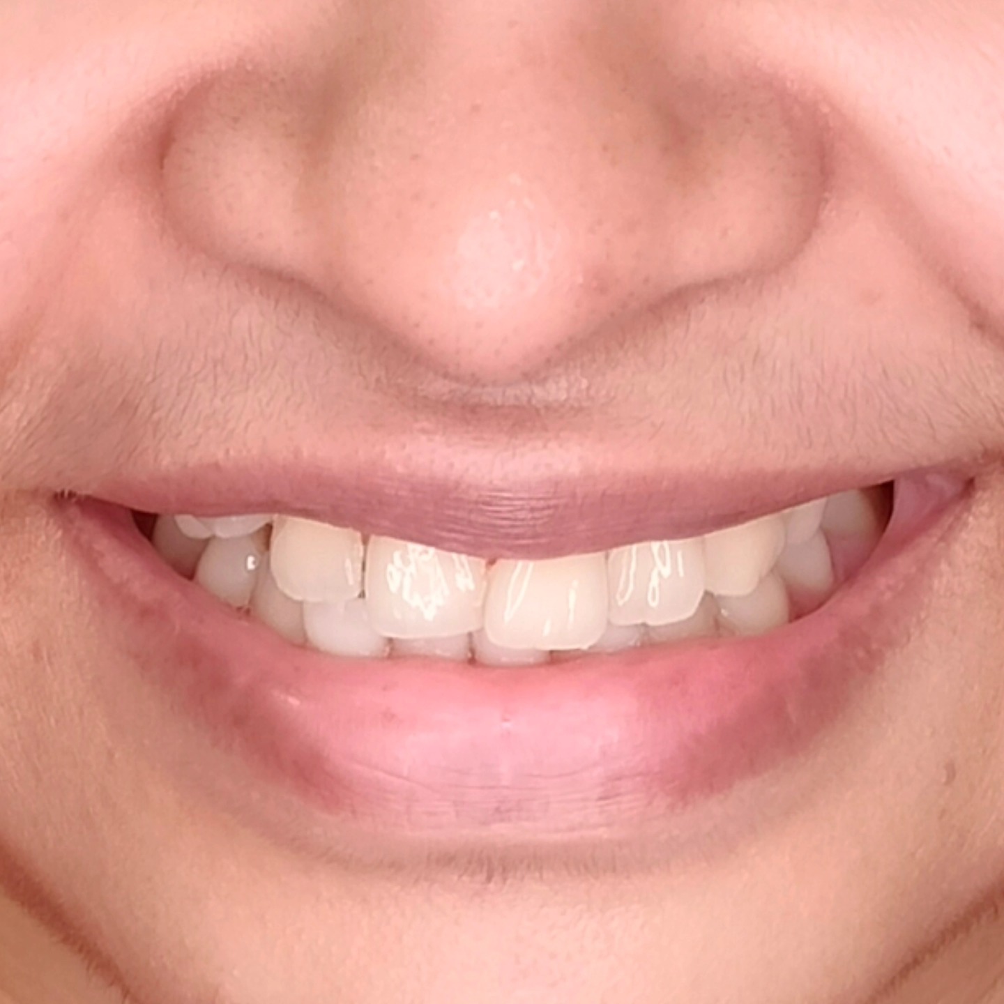 Correction of highly placed canine using fixed braces for a young lady.
Sethu's Dental House
Precise, Pleasant and Aesthetic Dentistry By Dr. Sethuraman Ramadoss MDS
#orthodontics #braces #dentistry #chennai #chrompet #sethusdentalhouse #smile #smilemakeover #aesthetic #estheticdentistry #esthetics #aestheticdentistry