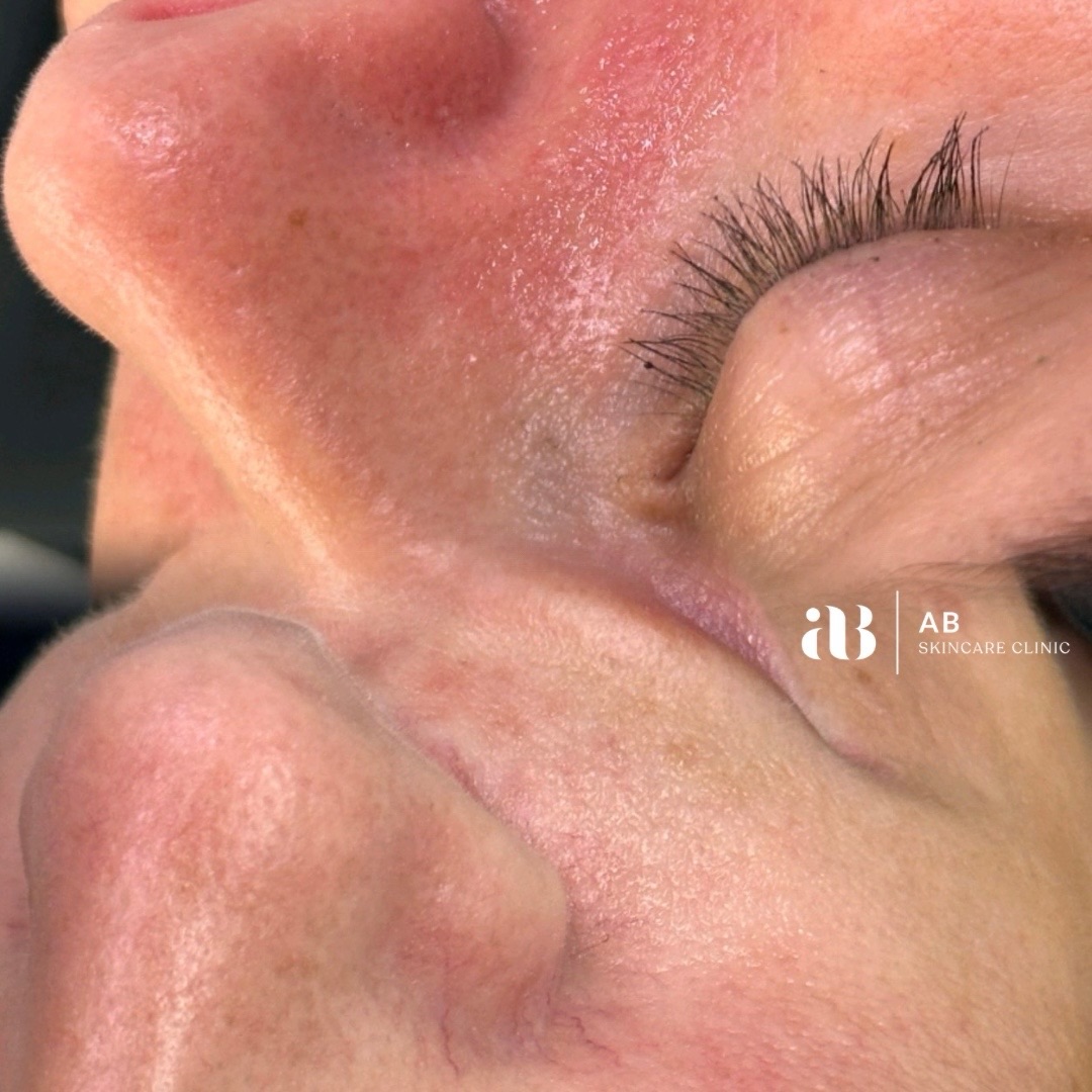Subtle, precise, and effective.
Thread vein removal around the nose — a delicate area that requires both expertise and the right technology to treat safely.
Thread veins do not disappear instantly. They gradually fade as the body naturally clears the treated vessels over time, revealing a calmer, more even complexion.
@abskincareclinic treatments are performed with precision, clinical expertise, and a results-driven approach, ensuring the safest and most effective outcome for your skin.
Refined results. Expert treatment. Skin confidence restored.
📲 Book your consultation today and experience the standard of care your skin deserves.
#skinclinicaouthwales #threadveinremoval #talbotgreen #pontyclun #skinspecialist