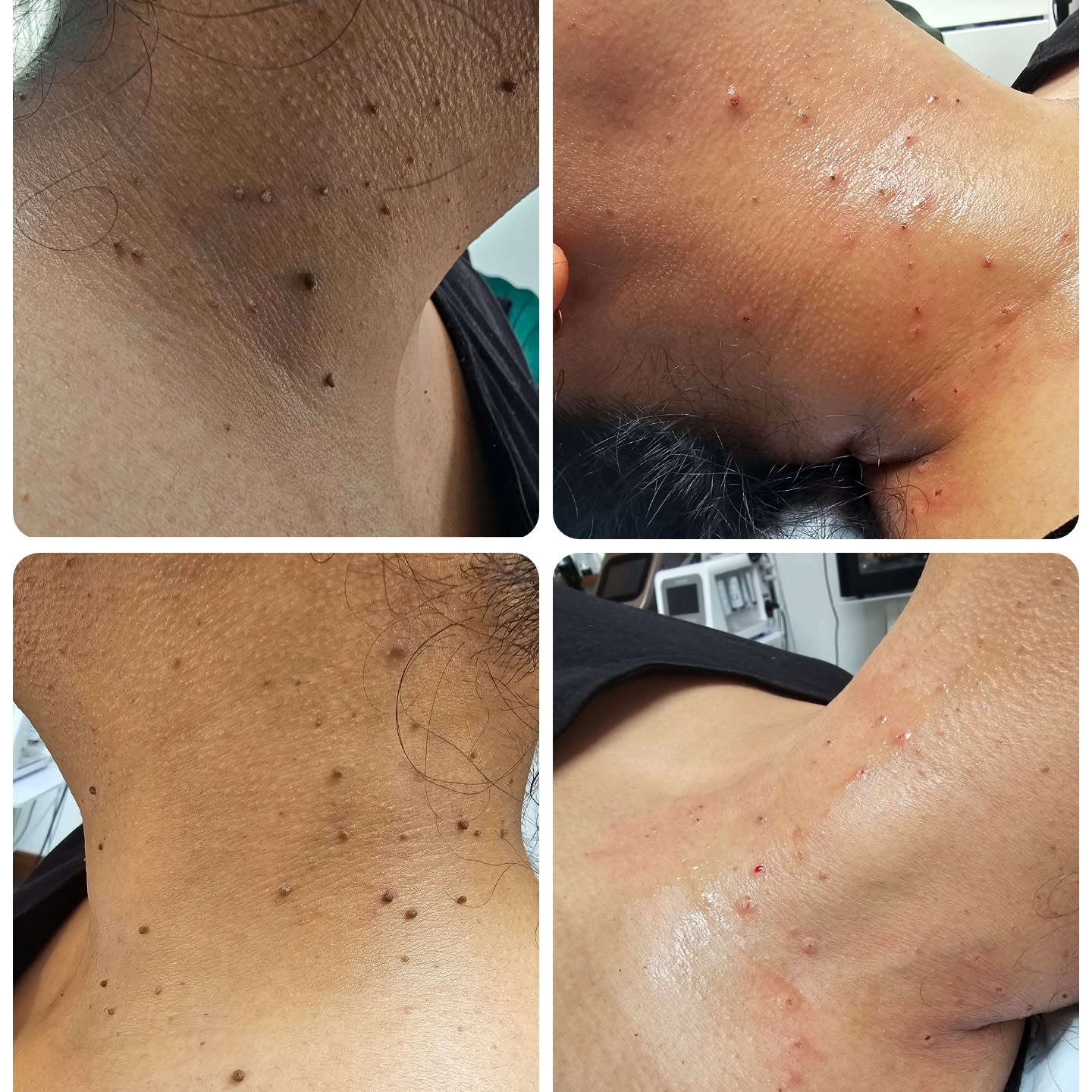 Skin tag removal instant results ! The rest will scab away.