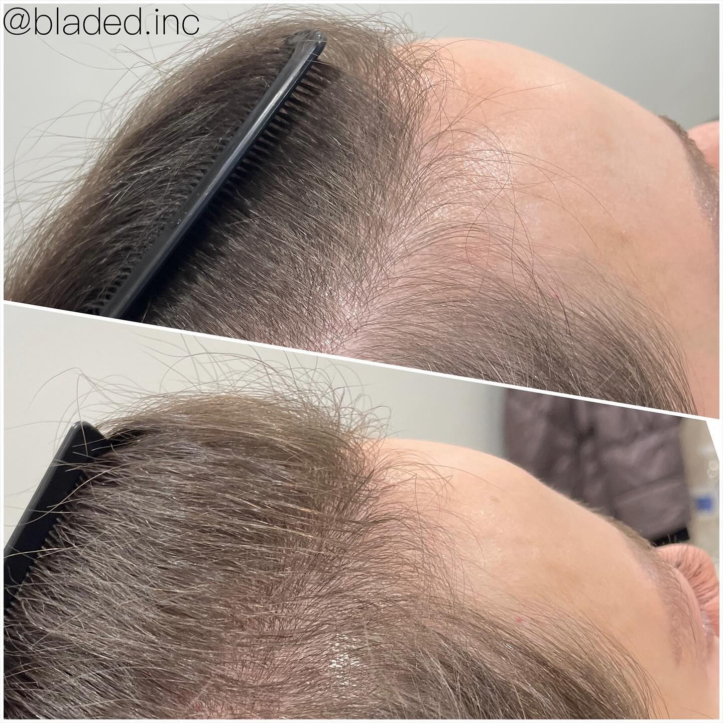 Before vs After 2 TED Hair restoration treatments 🤩
Swipe ⬅️to see all the little bouncing baby hairs 💁🏻♀️
#almated #tedhairrestoration #hairrestoration #zionsville #zionsvillemoms #zionsvillehair