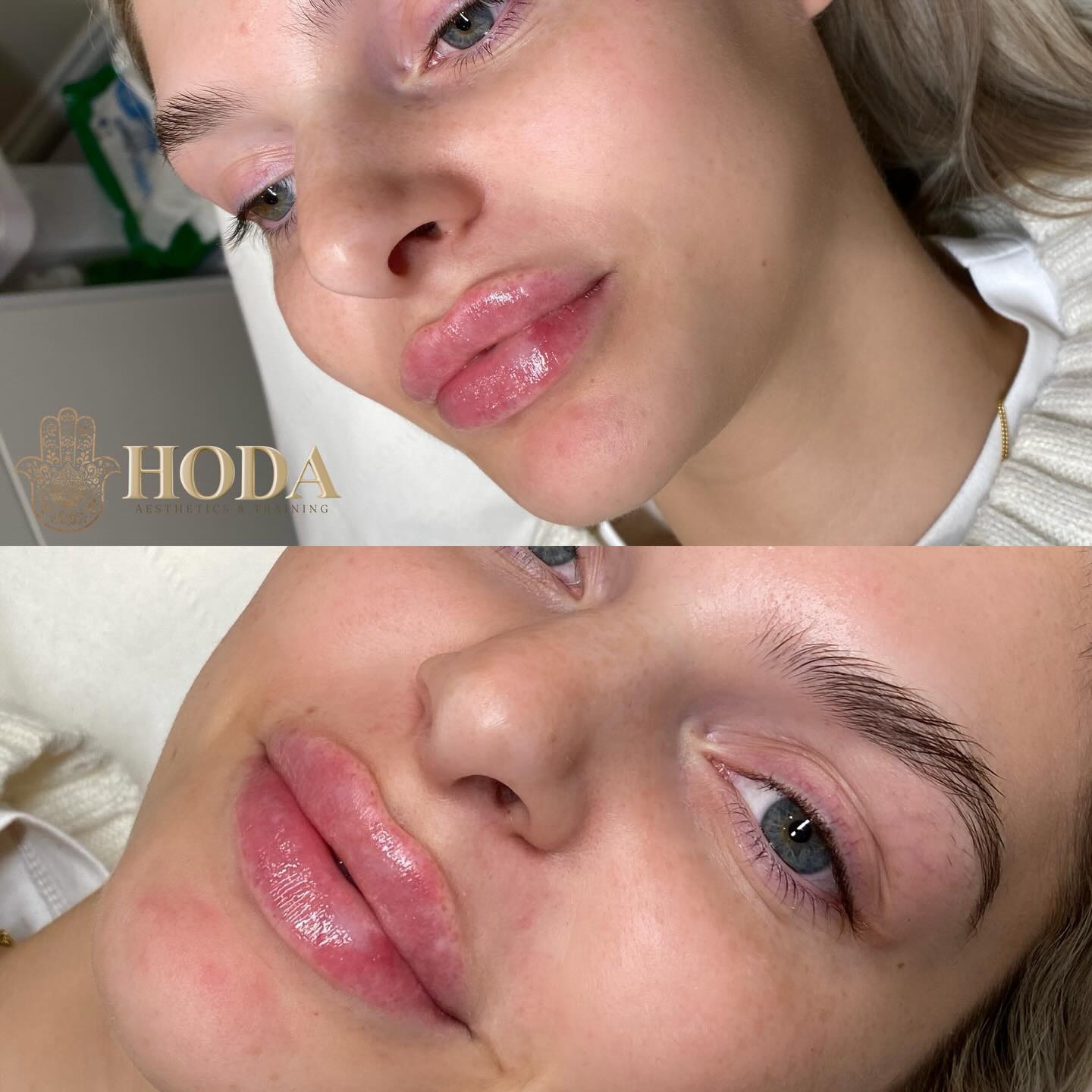 Before โก๏ธ After
Lip and cheek enhancement designed to add soft volume, gentle lift, and natural definition
๐ Lips: hydrated, defined, and plumper
๐ Cheeks: lifted, contoured and definition
The goal is always enhancementโnot transformation. Just a fresher, more confident you ๐
๐ฒ DM book with Hoda
๐ฉ๐ผโโ๏ธ Nurse Led-Aesthetic Clinic
๐ Bournemouth, Dorset
#bournemouthaesthetics #bournemouthclinic #bournemouthbeauty #dorsetaesthetics #cheekfillerbournemouth