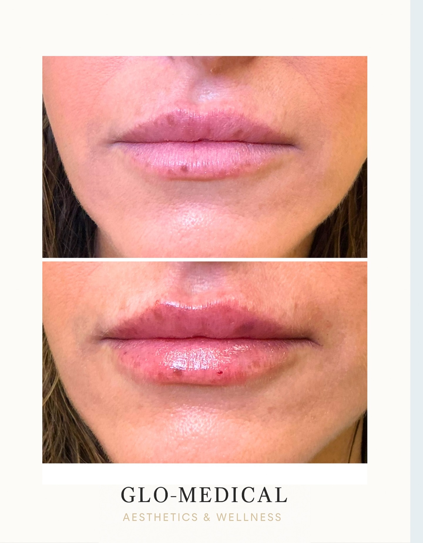 The goal isn’t bigger—it’s better 💉 👄
Restoring shape, hydration, and symmetry while keeping everything natural and soft.
This is what lip filler should look like