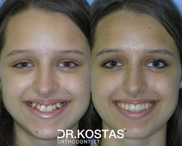 Face-driven orthodontics is our philosophy and key to success. Ema was unhappy with her smile and the appearance of her teeth. A non-extraction treatment approach was followed in her case with the Damon System and the results were more than rewarding. Hard work always pays off 😊👌
#drkostas #kostasortho #orthodontist #braces #dublinbraces #smile #smiletransformation #dublinorthodontist #smilemakeover #dublin #orthodontics #straightteeth #teethstraightening #damonbraces #smiletransformation #archwidening