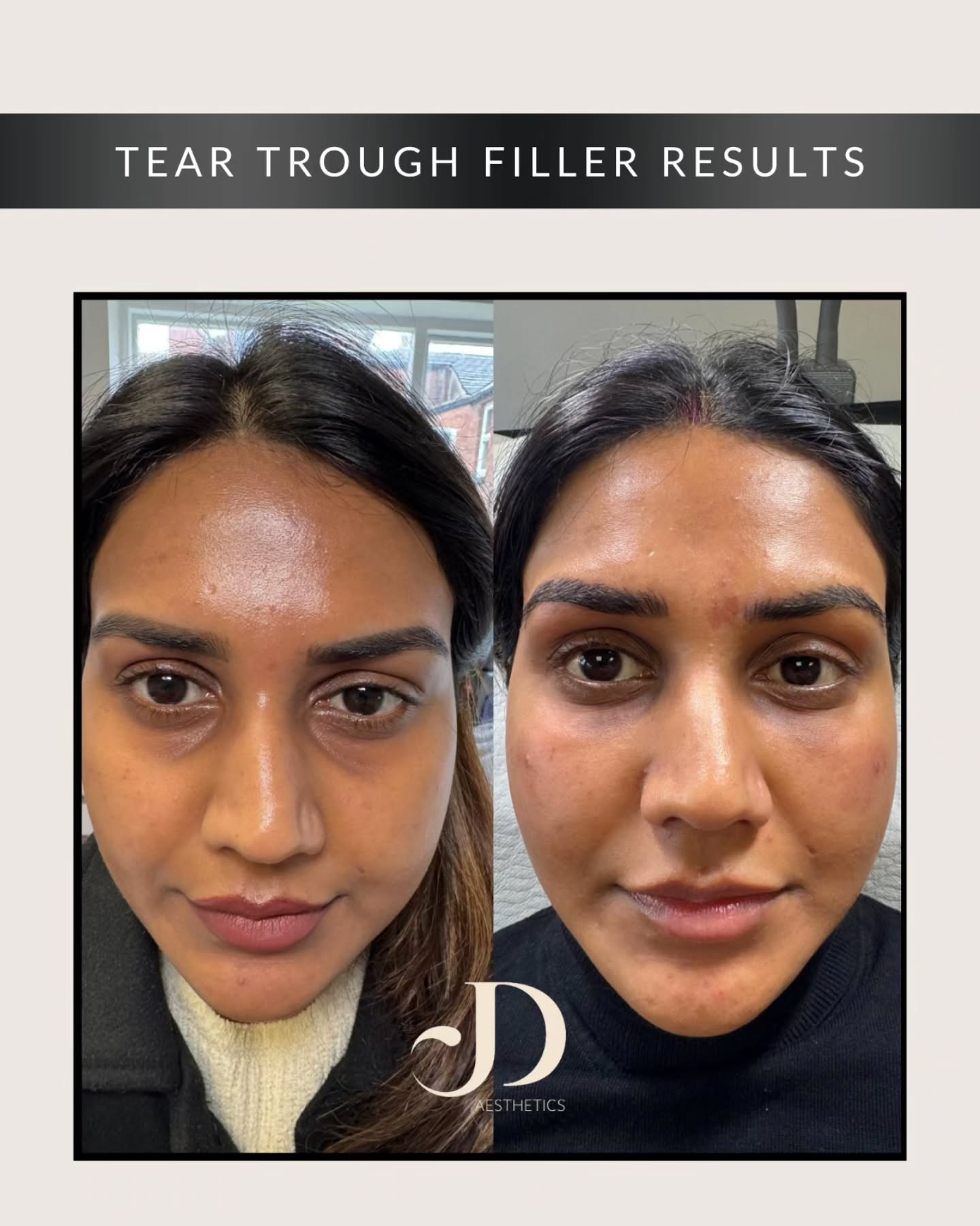 ✨ TIRED EYES? HOLLOW UNDER-EYES? LET’S FIX THAT ✨
Tear trough filler is a subtle, game-changing treatment that restores volume under the eyes, softens dark circles, and helps you look fresher, brighter, and more awake—without changing your natural features.
At The Point, we focus on enhancing—not overfilling—so you still look like you, just well-rested.
✔ Smooths hollows
✔ Reduces shadowing
✔ Brightens your whole face
✔ Minimal downtime
Your eyes say everything… let’s make sure they’re saying the right thing.
📍 Book your consultation today
#teartroughfiller #undereye #aestheticswarrington #teartroughfillerwarrington #teartroughfillercheshire