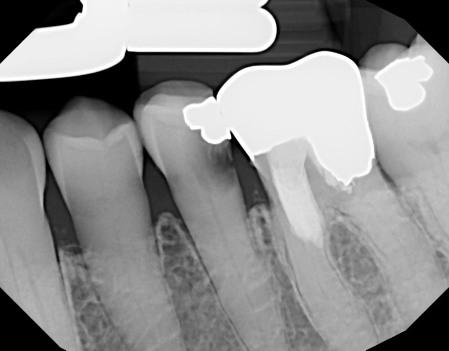 very calcified canal, i see someone else struggled with 36, 35 wasn't any easier, but we did it 🤓 i think i could do even better but i like documenting my endo progress... WL was 20.5mm, pt had a very hard time taking xrays 😩 but we did it 💪🏼
i am starting to like endo more and more.. 😅🦷🏝🐚🦪✨️