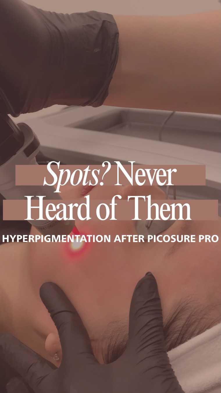 Picosure Pro works by delivering energy so fast that it doesnât create heat. No heat = less risk of triggering more hyperpigmentation, which is why itâs a great option for skin of colour.
Itâs one of the top lasers for hyperpigmentation, while also helping with skin rejuvenation. This means it helps minimize pores, smooth fine lines + wrinkles, and even out complexion.
Hyperpigmentation is cleared gradually, so multiple sessions are needed. Also, downtime is minimal. Youâll be a little pink for the day, and thatâs it!
Ready to get rid of your hyperpigmentation and never see it again? (with the understanding that maintenance is key to maintain results and treat any NEW pigment đ)
Book your Picosure Pro consultation today.
#picosurepro #lasertreatments #hyperpigmentation #wrinkles #northyorkskinclinic