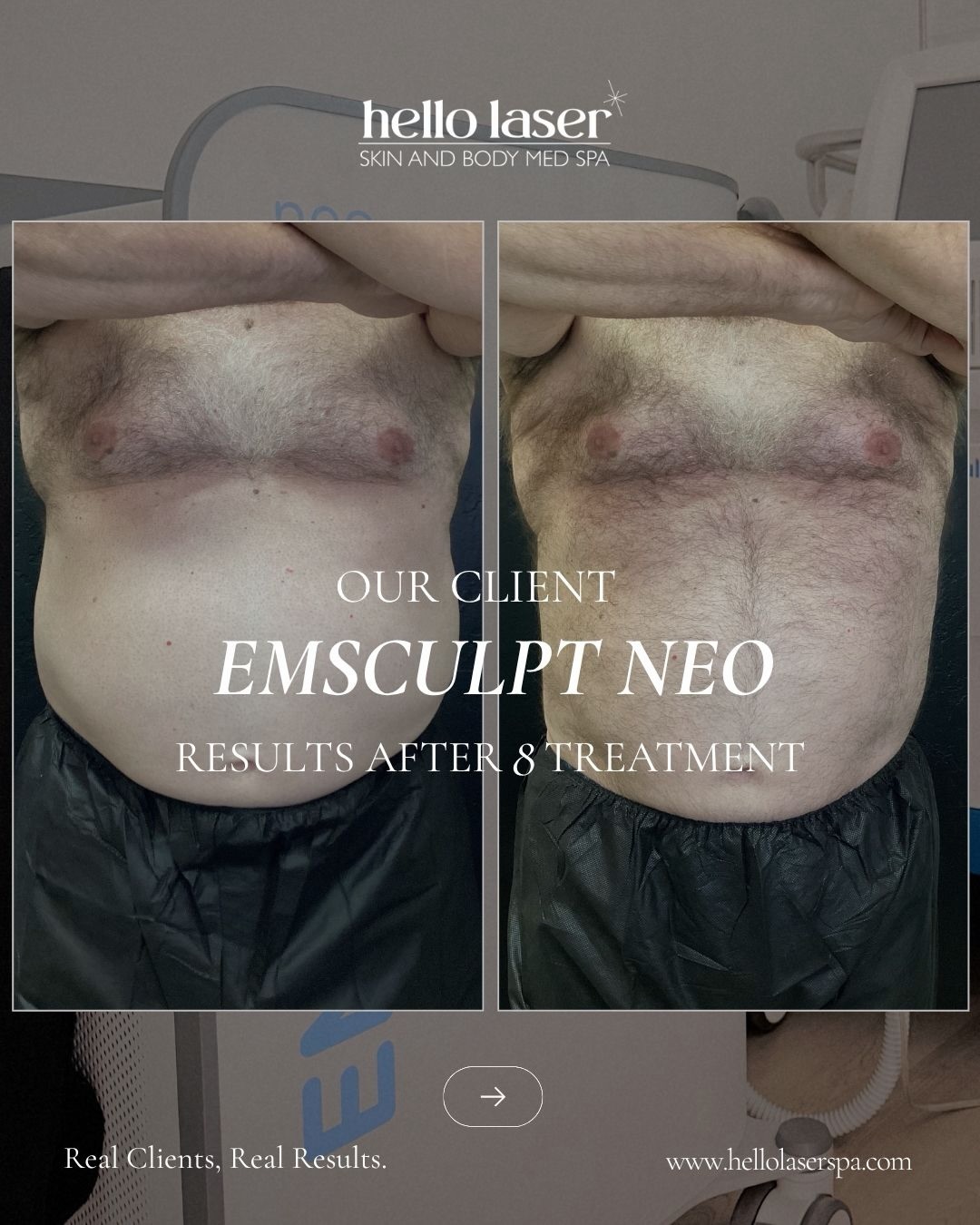 Imagine your dream body, without surgery or downtime. ✨
Emsculpt NEO is noninvasive, targets stubborn fat, and builds muscle so you can feel confident in your skin again. Scottsdale friends, now’s the time to make it happen!
Book online or call for our special promotion and save big.
📍 Scottsdale | 📞 480-905-3080
#NoninvasiveBodySculpting #EmsculptNEO #BodyTransformation #ScottsdaleWellness #HelloLaser