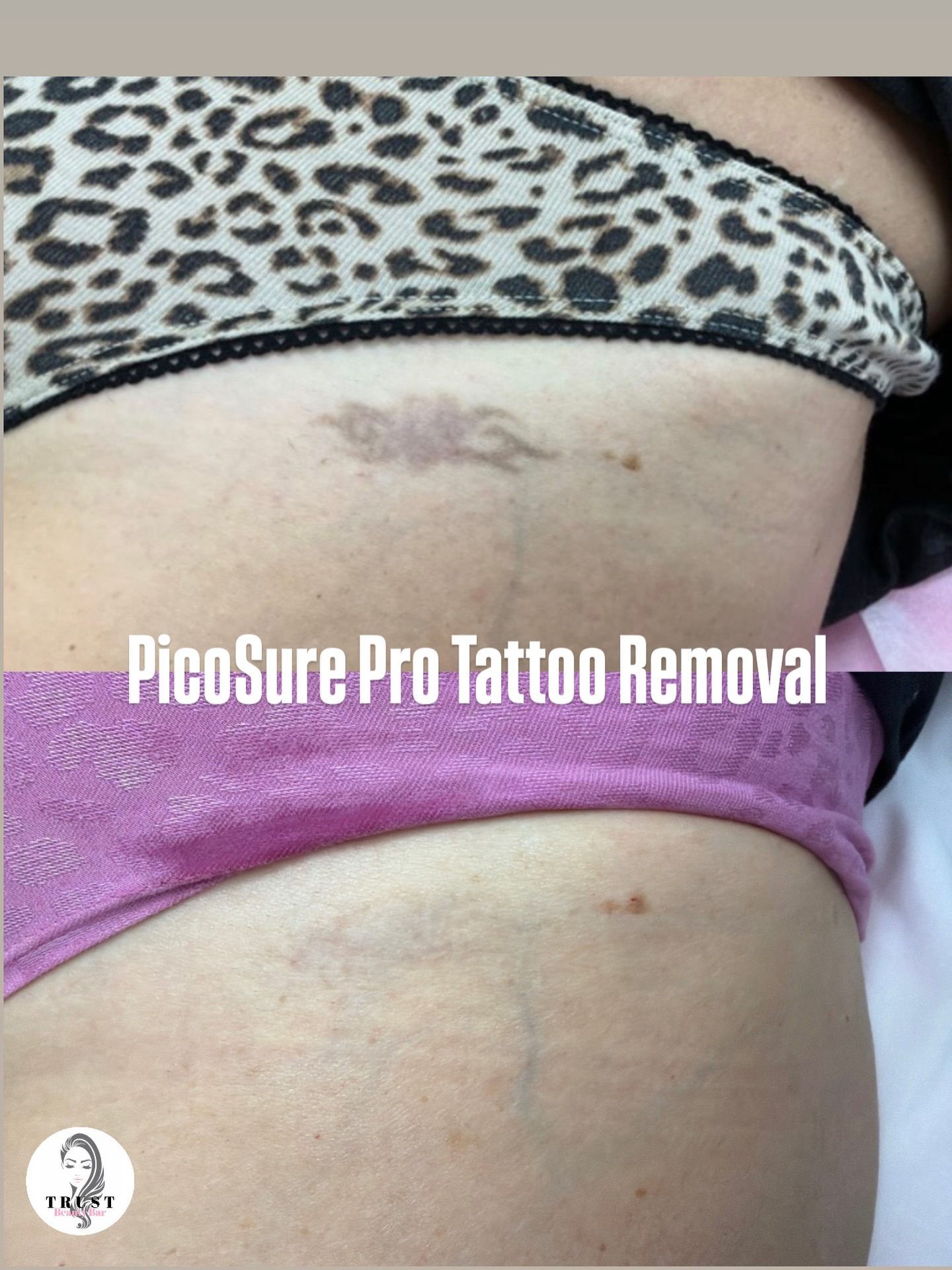 𝗣𝗜𝗖𝗢𝗦𝗨𝗥𝗘 𝗣𝗥𝗢 𝗥𝗘𝗦𝗨𝗟𝗧𝗦 𝗧𝗛𝗔𝗧 𝗦𝗣𝗘𝗔𝗞 𝗙𝗢𝗥 𝗧𝗛𝗘𝗠𝗦𝗘𝗟𝗩𝗘𝗦 ✨
This client came to us after multiple sessions with a traditional Q-switched laser… and still had significant residual pigment.
With our PicoSure Pro technology, we achieved near-complete removal in just 2 sessions.
➡️ Why the difference?
𝗣𝗶𝗰𝗼𝘀𝗲𝗰𝗼𝗻𝗱 𝘁𝗲𝗰𝗵𝗻𝗼𝗹𝗼𝗴𝘆 delivers ultra-short pulses that:
• Break ink into finer particles
• Target stubborn pigment more efficiently
• Reduce heat damage to surrounding tissue
• Allow the body to clear ink faster
This photo shows results after 2 sessions —
a final session was completed to clear residual “shadow ink.”
⚠️ Not all lasers are created equal.
⚠️ Not all protocols are advanced.
At Trust, we focus on precision, technology, and results — not just treatments.
𝗧𝗵𝗶𝘀 𝗶𝘀 𝘄𝗵𝗮𝘁 𝘁𝗿𝘂𝗲 𝗶𝗻𝗸 𝗰𝗹𝗲𝗮𝗿𝗮𝗻𝗰𝗲 𝗹𝗼𝗼𝗸𝘀 𝗹𝗶𝗸𝗲.
📍 Vaughan, ON
🔗 Book via link in bio
#PicoSurePro #TattooRemoval #LaserTattooRemoval #AdvancedAesthetics #tattoo