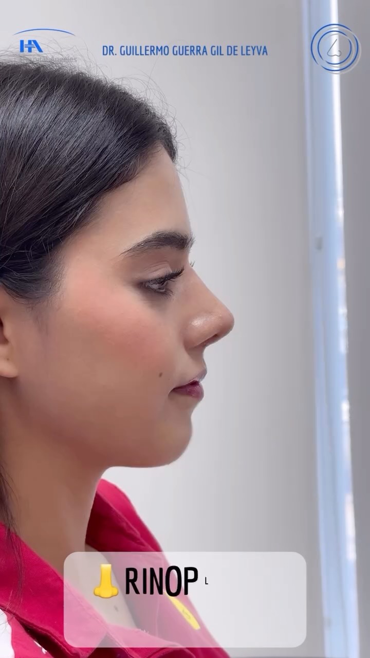 🔹 Tu satisfacción es nuestra prioridad. Cada Rinoplastia es diseñada para ti, considerando tus facciones y deseos.
🔹Evolución a un mes de Cirugía Nasal Estética y Funcional.
🔹 Gracias a mi excelente paciente por su confianza y permitir compartir su resultado.
🔹”Made by hand. Crafted with passion”
🧑⚕️ Dr. Guillermo Guerra Gil de Leyva
🏥 Hospital Ángeles Valle Oriente
📱 81-1252-0132
🎓Universidad de Monterrey
👃 Rinoplastia Estética y Funcional
🚫 No taponamiento
Cédula Profesional: 3070499
Cédula Especialista: 4503273
No. Certificación CONACEM: GUG-1748/04
Aviso de Publicidad COFEPRIS: 2419032002A00111
❕Paciente autoriza difusión de imágenes con fines académicos e informativos.
❕Los resultados finales se pudieran observar hasta un año de la cirugía y dependerá tanto del compromiso del cirujano como del paciente, así como del tipo de cirugía, tipo de piel, cuidados post-operatorios, etc.
#RinoplastiaPersonalizada #TuNarizTuEstilo
#rinoplastia #rhinoplasty #nosejob septoplasty rinoseptumplastia rhinoseptoplasty nosejob nose nosesurgery tabiquenasal otorrinolaringologia entsurgery cirugianasal cirugiatabique cirugiaesteticanasal
belleza confianza autoestima
cosmeticsurgery
otorrinolaringologiamonterrey otorrinomonterrey beforeandafter antesydespues
estructuredrhinoplasty
rinoplastiaestructurada
rinoplastiaultrasonica
ultrasonicrhinoplasty