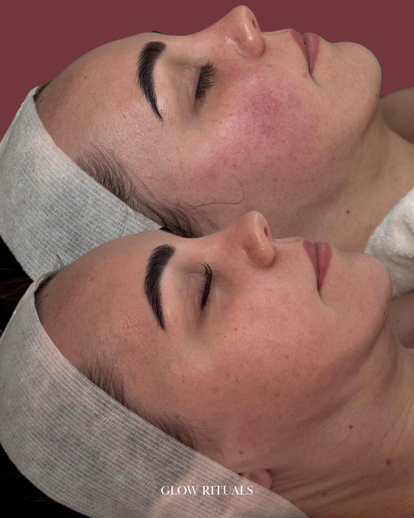 If you’ve been considering starting your skin needling journey this is your sign…
After just one session on my gorgeous client, we can already see a visible reduction in erythema (redness), with a more even, radiant complexion😍
Skin needling works by activating the skin’s natural healing response, stimulating collagen and elastin production. With each session, the skin becomes stronger, more resilient and better supported for that glow from within!
This is why I absolutely love skin needling for true long-term skin health✨
Ready to start your own skin needling journey at Glow Rituals?
👉🏻Explore our Advanced Skin Needling promo via the link in bio
🤍 Laura
#skinneedling #dermapen #microneedling #skinneedlingsydney #sydneyfacial