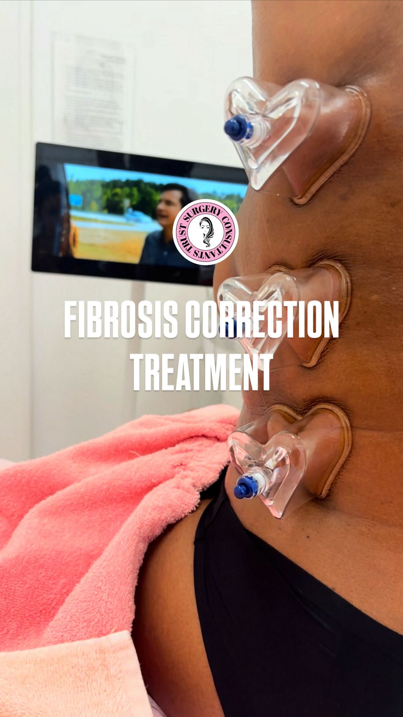 𝟏 𝐘𝐄𝐀𝐑 𝐎𝐋𝐃 𝐅𝐈𝐁𝐑𝐎𝐒𝐈𝐒 — 𝐓𝐇𝐈𝐒 𝐈𝐒 𝐖𝐇𝐄𝐑𝐄 𝐄𝐗𝐏𝐄𝐑𝐓𝐈𝐒𝐄 𝐌𝐀𝐓𝐓𝐄𝐑𝐒 📝
Not all fibrosis is the same… and chronic plaque fibrosis (1+ year) requires a completely different strategy.
At 𝐓𝐑𝐔𝐒𝐓, we don’t guess — we assess, layer, and treat with intention.
𝐎𝐔𝐑 𝐌𝐔𝐋𝐓𝐈-𝐌𝐎𝐃𝐀𝐋𝐈𝐓𝐘 𝐀𝐏𝐏𝐑𝐎𝐀𝐂𝐇:
✨ 𝐍𝐞𝐠𝐚𝐭𝐢𝐯𝐞 𝐂𝐨𝐦𝐩𝐫𝐞𝐬𝐬𝐢𝐨𝐧 (𝐒𝐢𝐠𝐧𝐚𝐭𝐮𝐫𝐞 𝐇𝐞𝐚𝐫𝐭𝐬)
→ Targeted decompression to soften dense fibrotic plaques and improve tissue mobility
✨ 𝐕𝐢𝐛𝐫𝐚𝐭𝐢𝐨𝐧 𝐓𝐡𝐞𝐫𝐚𝐩𝐲
→ Breaks adhesions + stimulates circulation within hardened tissue
✨ 𝐀𝐬𝐩𝐞𝐧 𝐓𝐡𝐞𝐫𝐚𝐩𝐲 (𝟏 𝐌𝐇𝐳 𝐓𝐡𝐞𝐫𝐚𝐩𝐞𝐮𝐭𝐢𝐜 𝐔𝐥𝐭𝐫𝐚𝐬𝐨𝐮𝐧𝐝)
→ Deep fascia release, scar remodeling & rehydration of fibrotic tissue
→ ONLY clinic in Canada offering this level of fibrosis technology
✨ 𝐌𝐚𝐧𝐮𝐚𝐥 𝐅𝐚𝐬𝐜𝐢𝐚 & 𝐌𝐚𝐬𝐬𝐚𝐠𝐞 𝐓𝐞𝐜𝐡𝐧𝐢𝐪𝐮𝐞𝐬
→ Restoring glide between tissue layers + improving contour + softness
⸻
𝐅𝐈𝐁𝐑𝐎𝐒𝐈𝐒 𝐂𝐀𝐍 𝐁𝐄 𝐂𝐎𝐑𝐑𝐄𝐂𝐓𝐄𝐃 𝐎𝐑 𝐈𝐌𝐏𝐑𝐎𝐕𝐄𝐃 — 𝐁𝐔𝐓 𝐈𝐓 𝐈𝐒 𝐍𝐎𝐓 𝐀 𝐐𝐔𝐈𝐂𝐊 𝐏𝐑𝐎𝐂𝐄𝐒𝐒.
Chronic cases require consistency, advanced techniques, and patience.
And in more severe fibrosis, results may need to be supported with injectable treatments or even secondary liposuction revision.
This is why proper guidance and early intervention matter.
⸻
𝐅𝐈𝐁𝐑𝐎𝐒𝐈𝐒 𝐈𝐒𝐍’𝐓 𝐏𝐄𝐑𝐌𝐀𝐍𝐄𝐍𝐓 — 𝐁𝐔𝐓 𝐈𝐓 𝐈𝐒 𝐓𝐄𝐂𝐇𝐍𝐈𝐐𝐔𝐄 𝐃𝐄𝐏𝐄𝐍𝐃𝐄𝐍𝐓.
The difference between staying stuck…
and seeing real change comes down to precision, experience, and the right