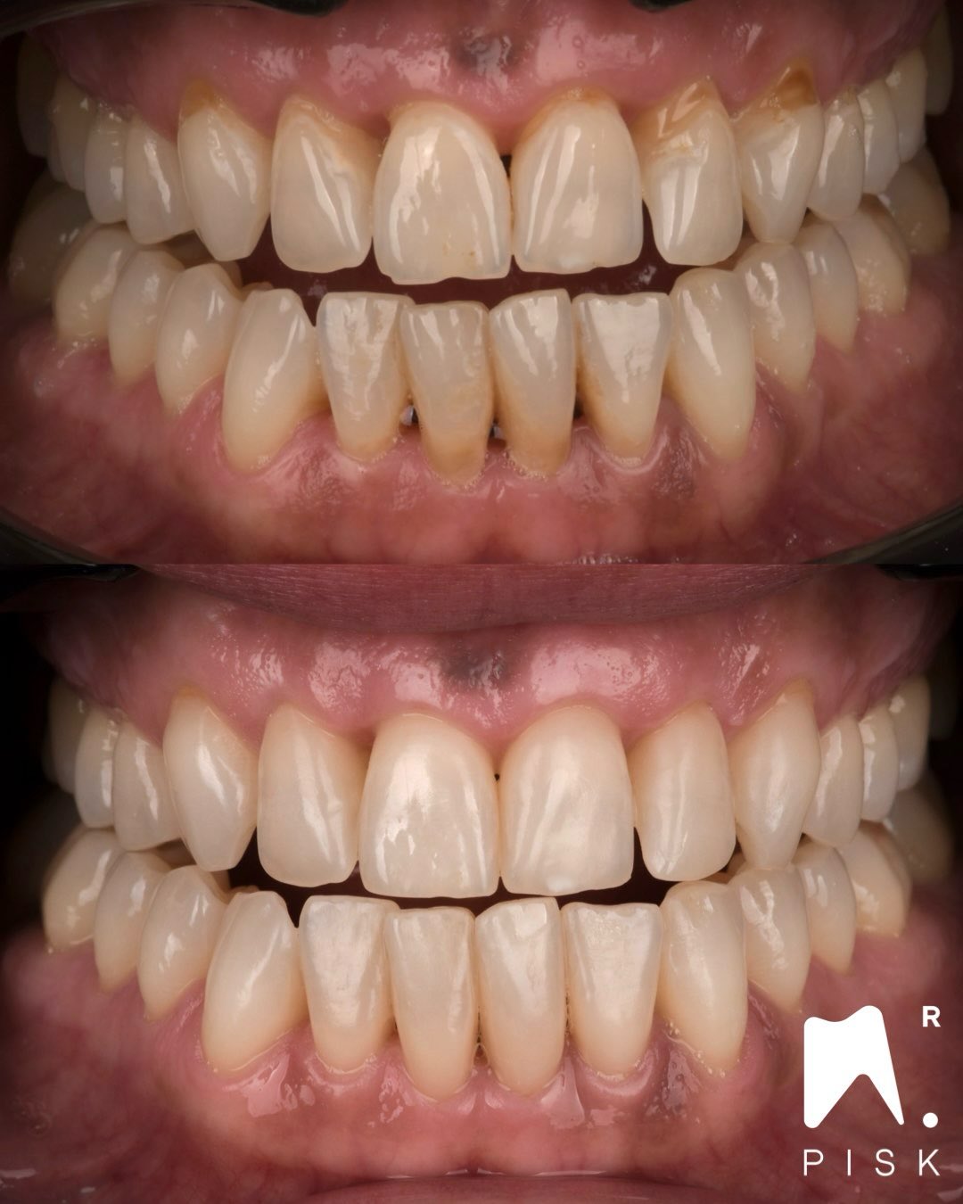 🇬🇧
Injection or freehand composite?
The purpose of the injection technique is to replicate a planned shape that would be difficult to achieve accurately with a freehand approach. However, its goal is not to create new emergence profiles.
In this case, freehand composite combined with transparent matrices was used to rebuild and precisely control the emergence profiles.
Key takeaway:
Although black triangles can be managed with injection, the gold standard remains freehand composite with matrices.
🇫🇷
Injection ou composite à main levée ?
Le but de la technique d’injection est de répliquer une forme planifiée que nous aurions du mal à obtenir de manière précise à main levée. En revanche, son objectif n’est en aucun cas de recréer de nouveaux profils d’émergence.
Dans ce cas clinique, nous avons utilisé du composite à main levée associé à des matrices transparentes afin de reconstruire et contrôler les profils d’émergence.
À retenir :
Il est possible de fermer des triangles noirs avec l’injection, mais la technique de choix reste le composite conventionnel à main levée avec matrices.