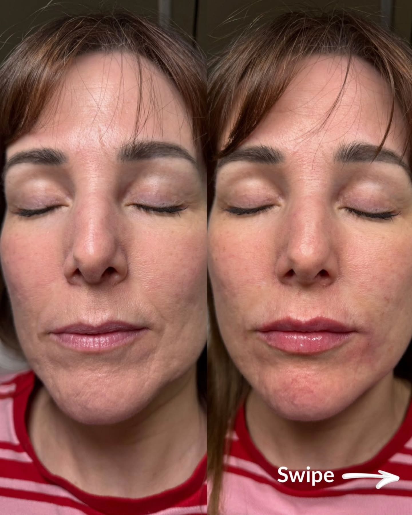 ✨ SOFTEN, RESTORE, REFRESH ✨
Subtle changes… real impact. 💫
With the right dermal filler, we can gently soften nasal folds while restoring natural volume to the lips — creating a fresher, more balanced look without overfilling.
The result?
A smoother, more youthful appearance that still looks completely like YOU. 🤍
✨ Softened lines
✨ Restored volume
✨ Natural, refreshed finish
Results typically last 9–18 months, making this the perfect treatment for long-lasting confidence.
Ready for a refresh, not a transformation? Message to book your consultation. 📩
#lipfiller #naturalenhancement #aestheticswarrington #warringtonaesthetics #nasolabialfolds