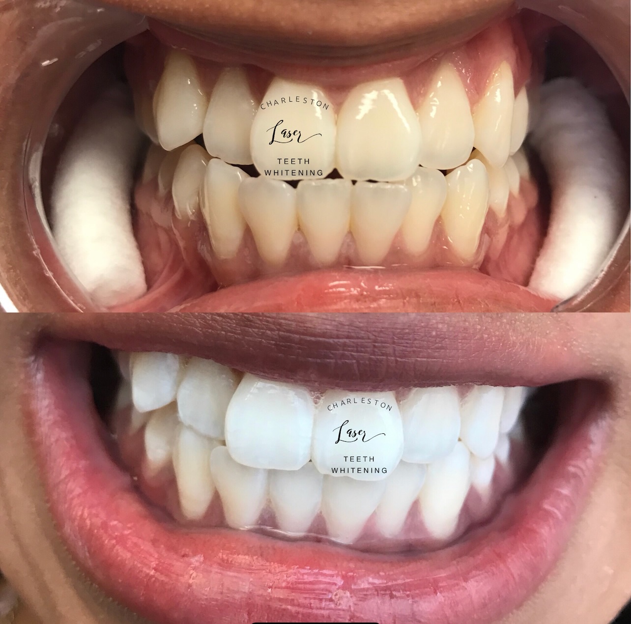 It’s not about trying to stand out, it’s about being so put together, you naturally do. 🦷✨
Book your teeth whitening now!
www.CharlestonLaserTeethWhitening.com
#teethwhitening #charlestonteethwhitening #charleston #charlestonsc #charlestonlaserteethwhitening mountpleasant mountpleasantsc kiawahisland kiawahjamesisland westashley isleofpalms downtowncharleston sullivansisland johnsisland johnsisland northcharleston northcharlestonsc folly follybeach laserteethwhitening