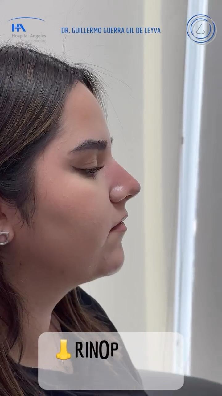 🔹 La Rinoplastia Personalizada se adapta a tu rostro, tus rasgos y tus expectativas. Natural, armónica y única.
🔹Evolución a un mes de Cirugía Nasal Estética y Funcional.
🔹 Gracias a mi excelente paciente por su confianza y permitir compartir su resultado.
🔹”Made by hand. Crafted with passion”
🧑⚕️ Dr. Guillermo Guerra Gil de Leyva
🏥 Hospital Ángeles Valle Oriente
📱 81-1252-0132
🎓Universidad de Monterrey
👃 Rinoplastia Estética y Funcional
🚫 No taponamiento
Cédula Profesional: 3070499
Cédula Especialista: 4503273
No. Certificación CONACEM: GUG-1748/04
Aviso de Publicidad COFEPRIS: 2419032002A00111
❕Paciente autoriza difusión de imágenes con fines académicos e informativos.
❕Los resultados finales se pudieran observar hasta un año de la cirugía y dependerá tanto del compromiso del cirujano como del paciente, así como del tipo de cirugía, tipo de piel, cuidados post-operatorios, etc.
#RinoplastiaPersonalizada #TuNarizTuEstilo
#rinoplastia #rhinoplasty #septoplastia septoplasty rinoseptumplastia rhinoseptoplasty nosejob nose nosesurgery tabiquenasal otorrinolaringologia entsurgery cirugianasal cirugiatabique cirugiaesteticanasal
belleza confianza autoestima
cosmeticsurgery
otorrinolaringologiamonterrey otorrinomonterrey beforeandafter antesydespues
estructuredrhinoplasty
rinoplastiaestructurada
rinoplastiaultrasonica
ultrasonicrhinoplasty