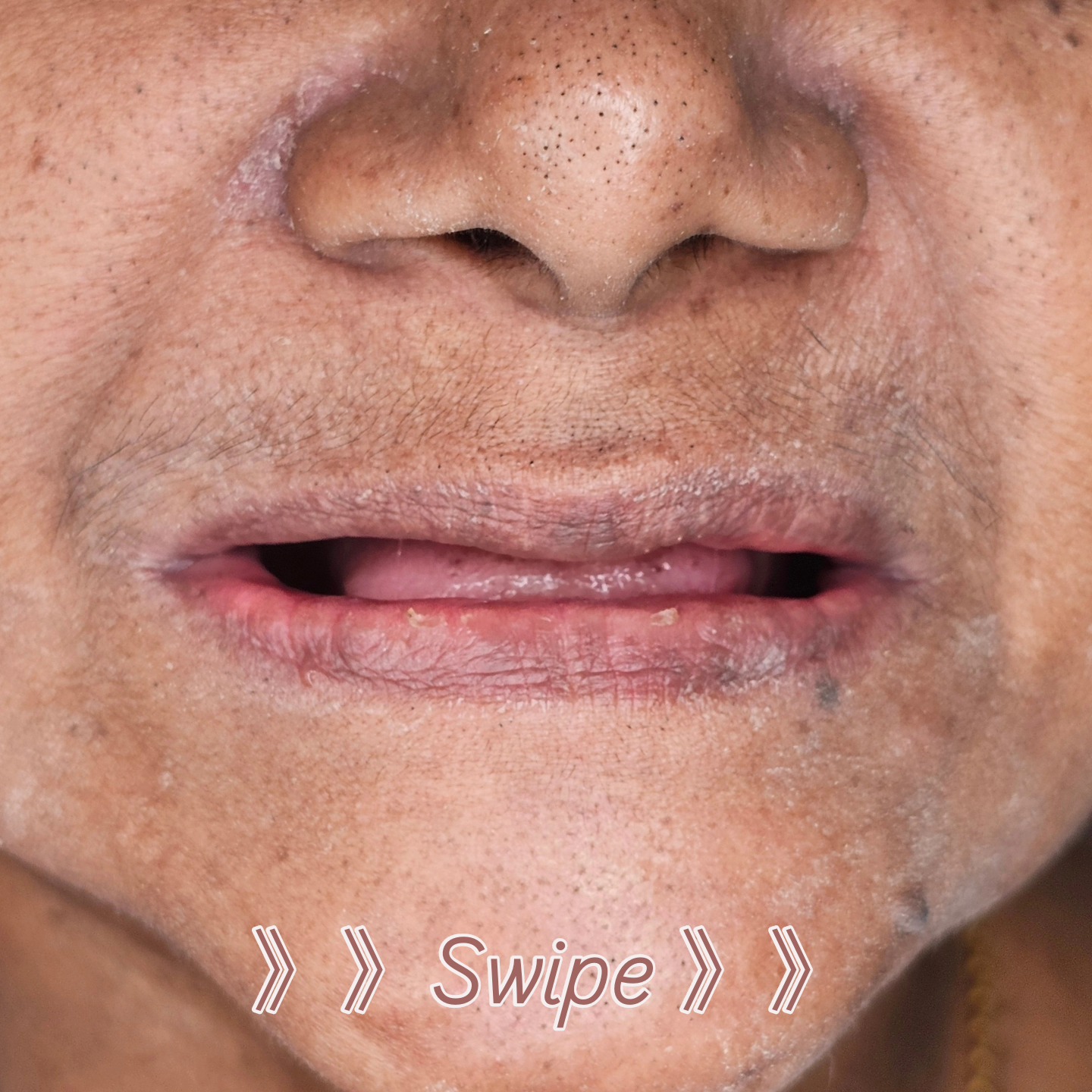 Rehabilitation of complete dentition using removable dentures made the right way.
Swipe to see the transformation.
For dental queries contact Sethu's Dental House - 9789247362
Lab support - @lncreative35
Precise, Pleasant and Aesthetic Dentistry in Chrompet, Chennai
#ivoclar #dentures #denture #bps #injectionmolding #sethusdentalhouse