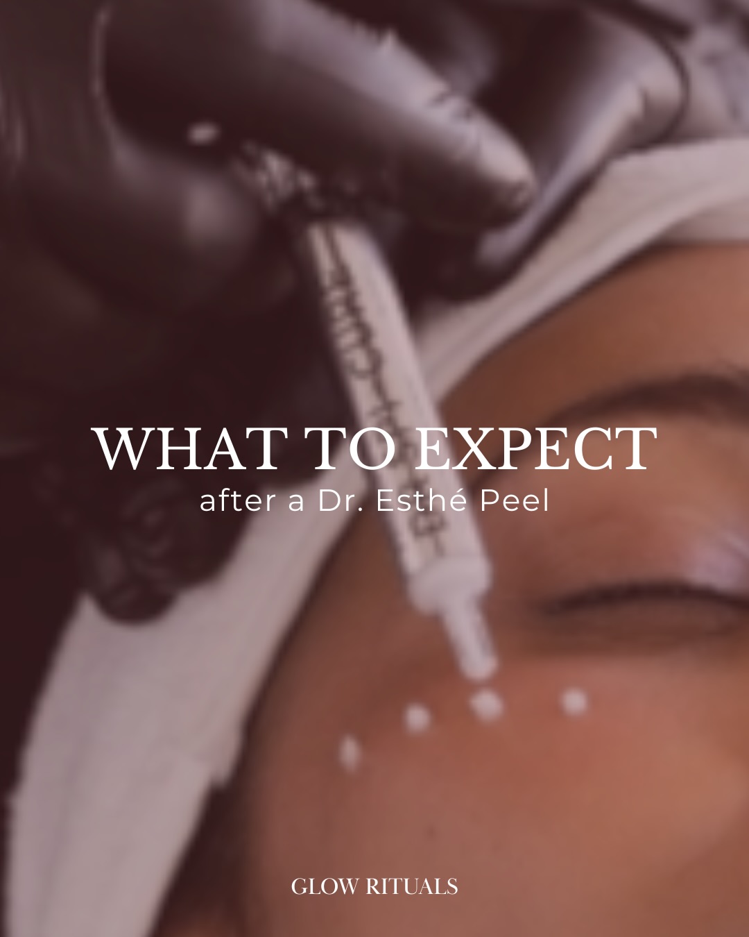 What to expect from our Dr. Esthé Peels✨
During your treatment the peel is gently massaged into the skin. You’ll notice a warm and tingly sensation, almost like rubbing sand on your skin. Strange but completely bearable and I promise the results are worth it🤭
Immediately after you may notice some redness and warmth (think mild sunburn vibes). By days 3-5 some light flaking and dryness is to be expected but is totally normal!
After 1 week your skin will settle right down and that’s when you start to see the real magic 🪄
Think clearer, smoother, more radiant skin 😍
No wonder it’s quickly becoming a favourite in salon, when the results speak for themselves!
Want to save $150?
Prepay a series of 3 for long-lasting results!
👉🏻 head to our website or link in bio to save
🤍 Laura
#dresthe #kbeauty #skinrejuvenation #skinresurfacing #sydneyskinclinic