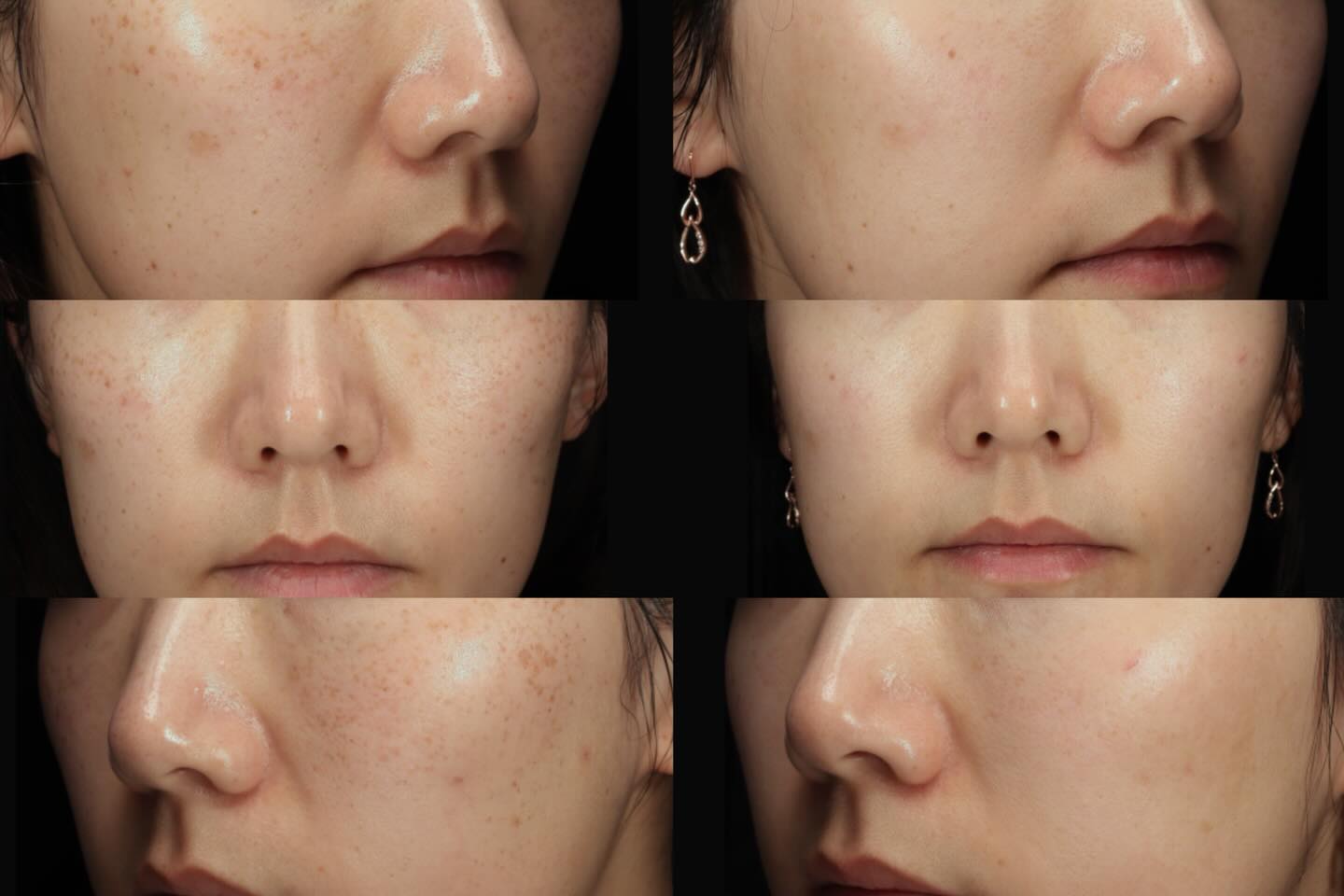 Incredible results with only 2️⃣ session of Helios Spot treatment. You don’t have to wait till winter to see the magic, it works well during all Seasons. Book a consultation with Dillon at Le Mon Aesthetics💫
By our Lead RN Dillon
#lemonspamtv #medicalspa #picolaser #helios785