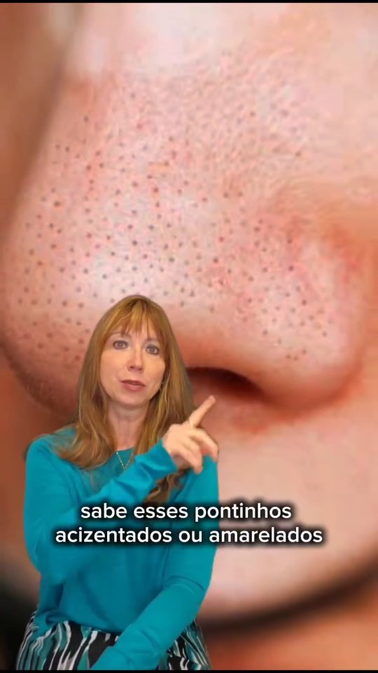 Pare de espremer o seu nariz agora! 🚫👃
Sabe esses pontinhos que você vive tentando "limpar" na frente do espelho? Na maioria das vezes, eles não são cravos, mas sim Filamentos Sebáceos — uma estrutura natural e necessária para a saúde da sua pele.
Ao espremer, você não está limpando; você está dilatando seus poros e destruindo a elasticidade da pele. O resultado?
Poros cada vez maiores e mais visíveis. 🧬🥺
▶️ Assista ao vídeo para entender a diferença e como tratar do jeito certo, sem agressão!!!
QUER O MEU GUIA DE ATIVOS?
Eu preparei o passo a passo para deixar o nariz lisinho sem precisar espremer nada.
👇 Comenta "ROTINA" que eu te envio agora no Direct!