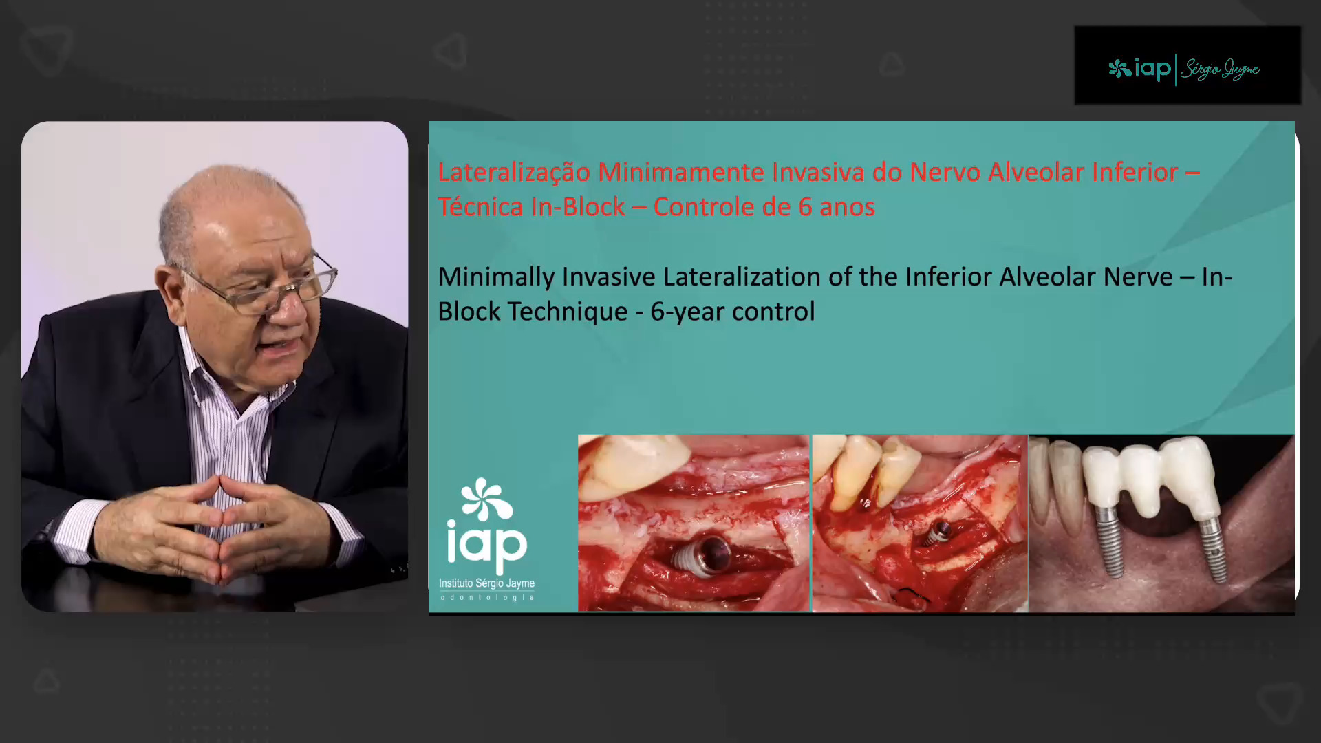 Lateralização Minimamente Invasiva do Nervo Alveolar Inferior – Técnica In-Block – Controle de 6 anos
Minimally Invasive Lateralization of the Inferior Alveolar Nerve – In-Block Technique - 6-year control
TÉCNICA OPERATÓRIA
É realizada no corpo mandibular sem incluir o forame mentoniano e é removido um bloco ósseo para a completa visualização do nervo alveolar para a instalação do implante. Esse bloco é reposicionado e fixado por micro-parafusos.
Obs: Cirurgia realizada no Curso de Cirurgia Avançada do IAP-Sérgio Jayme
Av. Paulista, 91 Cj 402 Tel (11)5572-1283 / Cel e WhatsApp (11)94888-2000 CEP:01311-000 São Paulo-SP
Av. Rubem Berta, 1461 Tel (11)2276-2217 / Cel e WhatsApp (11)98383-3941 CEP: 04074-010 São Paulo-SP
#implante #periodontia #curso #rog #enxertoosseo #enxerto #iap #protesedental #protesedentaria #regeneracaoosseaguiada #cargaimediata #sergiojayme #sergiojaime #cienciaemvideo #implantesdentarios #implantes #implant #implants #implantdentistry #implantology #implantodontia #geistilich #nobelbiocare #iapcursos #lateralizacaodonervoalveolar #transposicaodonervoalveolar #implantec #piezo #piezosurgery