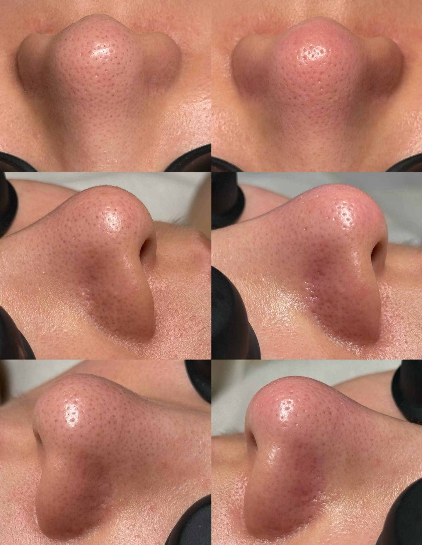 Before → After ✨
Blackheads, congestion, dullness… gone.
Our Hydrafacial deeply cleanses every pore while infusing hydration back into the skin — leaving you with that smooth, refined, glass-skin glow.
You’re not just cleaning your skin.
You’re resetting it.
✔️ Deep pore detox
✔️ Instant glow
✔️ Hydration + barrier support
Once you try it, there’s no going back.
Facial by Master Esthetician Nicole
#Hydrafacial #PoreCare #GlassSkin #SkinTexture #medicalaesthetics