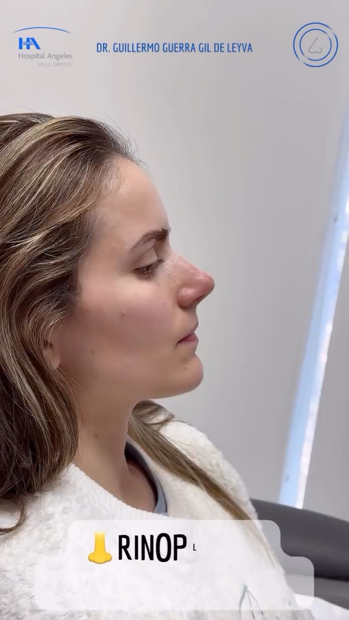 🔹Apenas 3 semanas y ya se empieza a notar una nariz más armoniosa sin perder su esencia. La verdadera transformación está en lo sutil.
🔹Evolución a tres semanas de Rinoplastia
🔹 Gracias a mi excelente paciente por su confianza y permitir compartir su resultado.
🔹”Made by hand. Crafted with passion”
🧑⚕️ Dr. Guillermo Guerra Gil de Leyva
🏥 Hospital Ángeles Valle Oriente
📱 81-1252-0132
🎓Universidad de Monterrey
👃 Rinoplastia Estética y Funcional
🚫 No taponamiento
Cédula Profesional: 3070499
Cédula Especialista: 4503273
No. Certificación CONACEM: GUG-1748/04
Aviso de Publicidad COFEPRIS: 2419032002A00111
❕Paciente autoriza difusión de imágenes con fines académicos e informativos.
❕Los resultados finales se pudieran observar hasta un año de la cirugía y dependerá tanto del compromiso del cirujano como del paciente, así como del tipo de cirugía, tipo de piel, cuidados post-operatorios, etc.
#rinoplastia #rhinoplasty #septoplastia #septoplasty #rinoseptumplastia #rhinoseptoplasty #nosejob #nose #nosesurgery #tabiquenasal #otorrinolaringologia #entsurgery #cirugianasal #cirugiatabique #cirugiaesteticanasal
#belleza #confianza #autoestima
#cosmeticsurgery
#otorrinolaringologiamonterrey #otorrinomonterrey #beforeandafter #antesydespues
#estructuredrhinoplasty
#rinoplastiaestructurada
#rinoplastiaultrasonica
#ultrasonicrhinoplasty