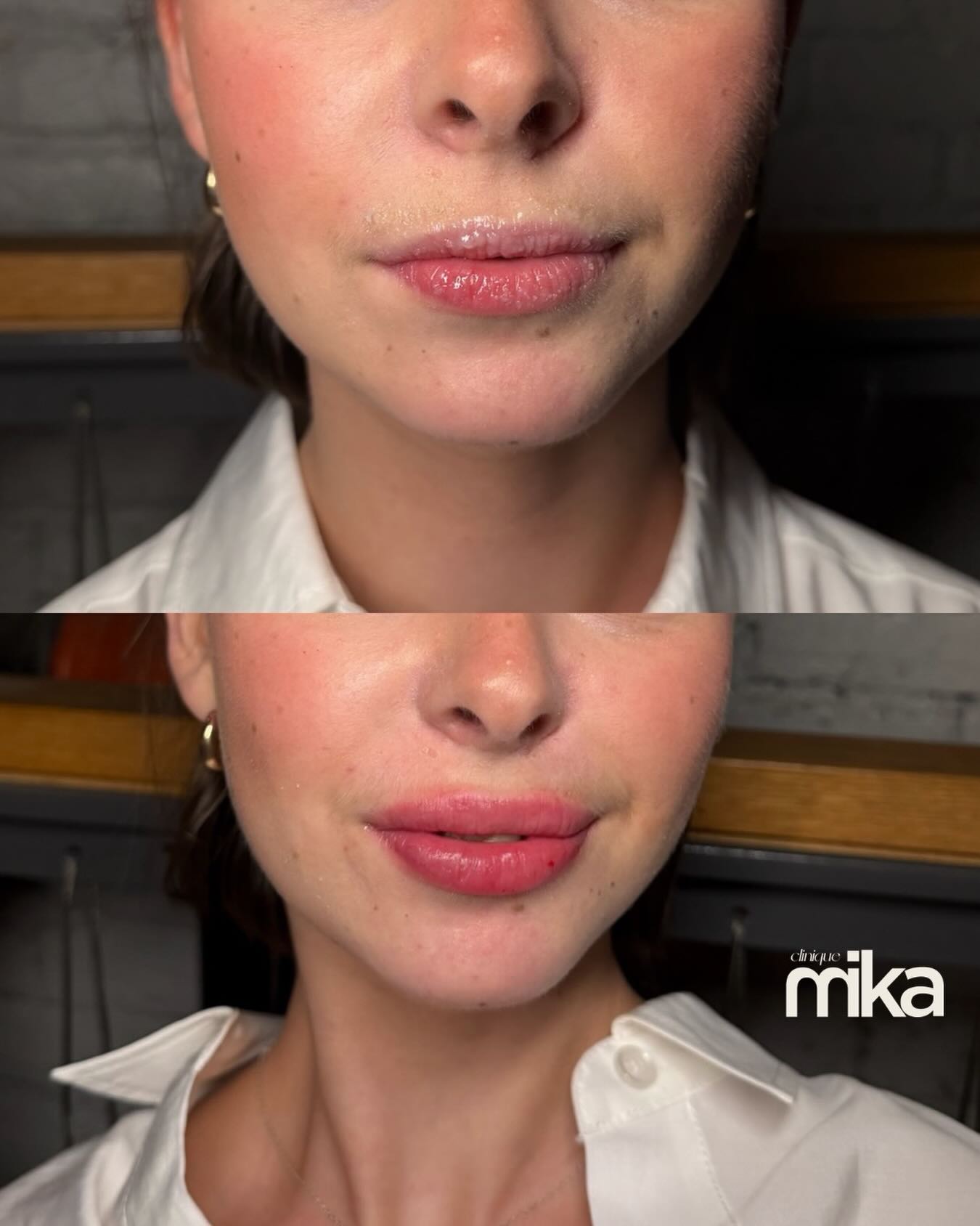 Subtle volume. Balanced definition.
Lip filler at Clinique Mika is designed to enhance—not transform. We focus on restoring hydration, refining shape, and correcting asymmetries for results that feel natural and tailored to you. Book your consultation via the link in bio or call 514-384-6262.
Treatment done by Dr. Marie-Ève | Real patient signed photo consent obtained for publications that are only used as an example. Results shown not guaranteed for every client.
Volume subtil. Définition équilibrée.
Les injections aux lèvres chez Clinique Mika sont pensées pour sublimer—jamais transformer. Notre approche vise à réhydrater, redéfinir le contour et corriger les asymétries pour un résultat naturel, harmonieux et adapté à chaque visage. Pour réserver une consultation, cliquez sur le lien en bio ou appelez le 514-384-6262.
Traitement effectué par la Dre Marie-Ève | Consentement à la photo signé par la vraie patiente obtenu pour les publications utilisées à titre d’exemple seulement. Les résultats peuvent varier d’un patient à l’autre.