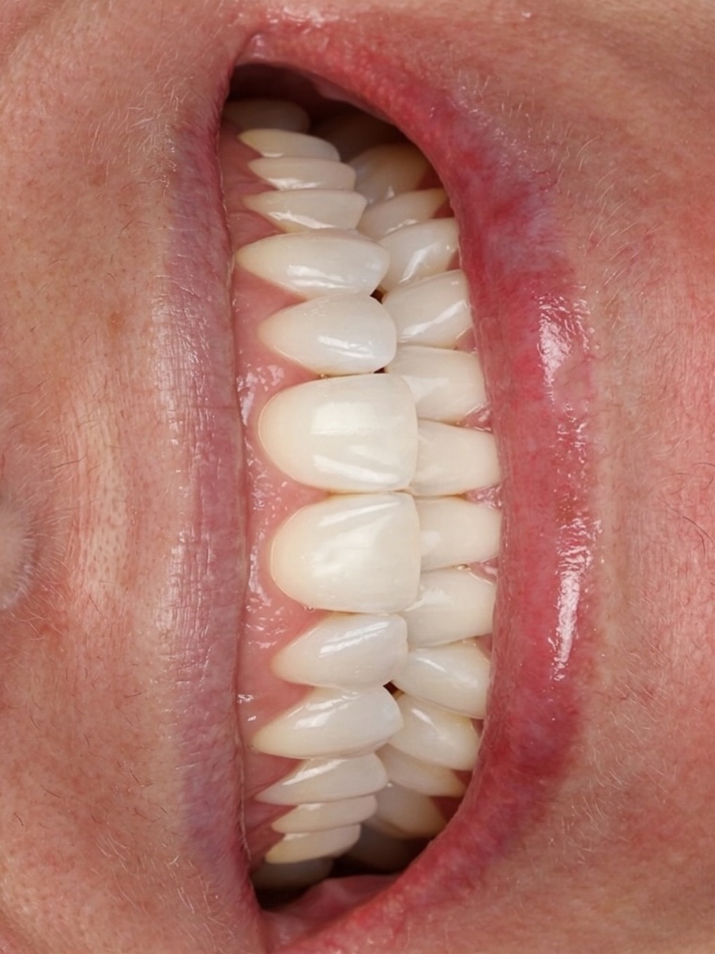 Não tem como a sexta-feira não começar bem, depois de uma consulta de acompanhamento de clareamento com esse resultado lindo! 🌷
CLÍNICA PATO | Há 50 anos transformando sorrisos e cuidando de famílias